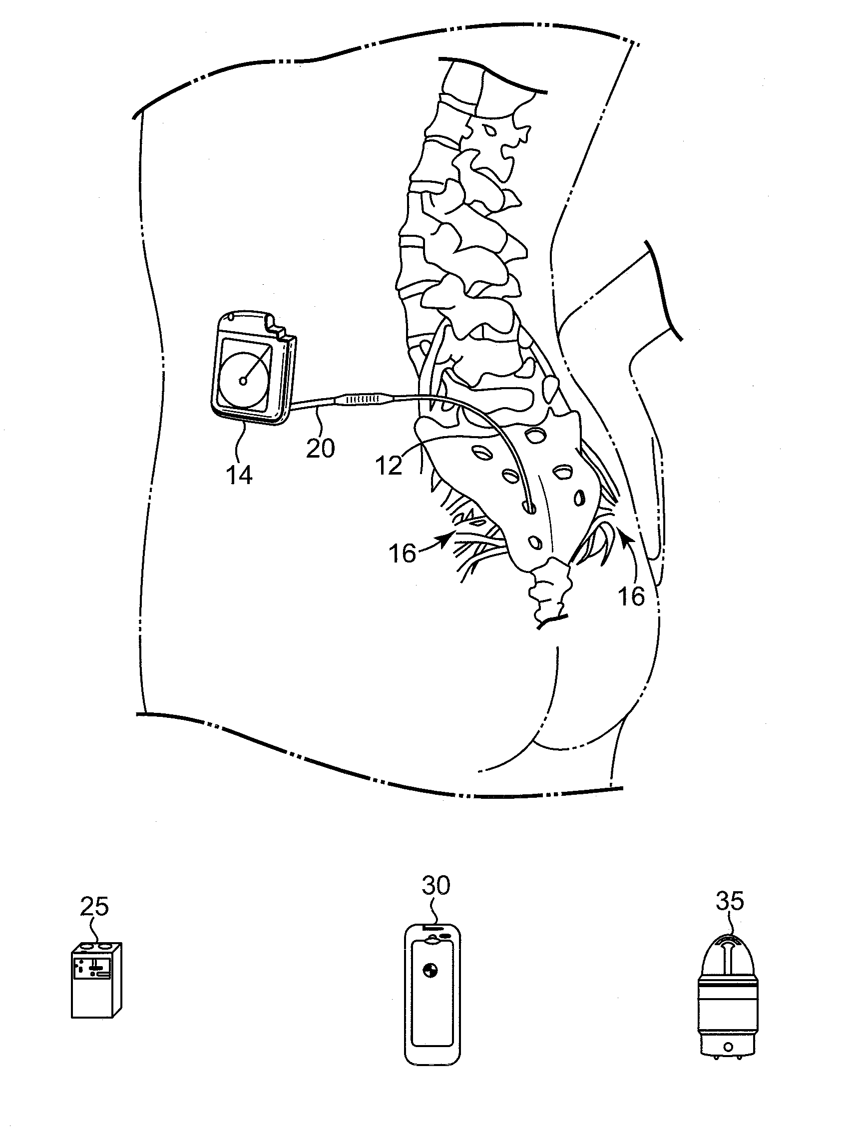 Voltage/current regulator improvements for an implantable medical device