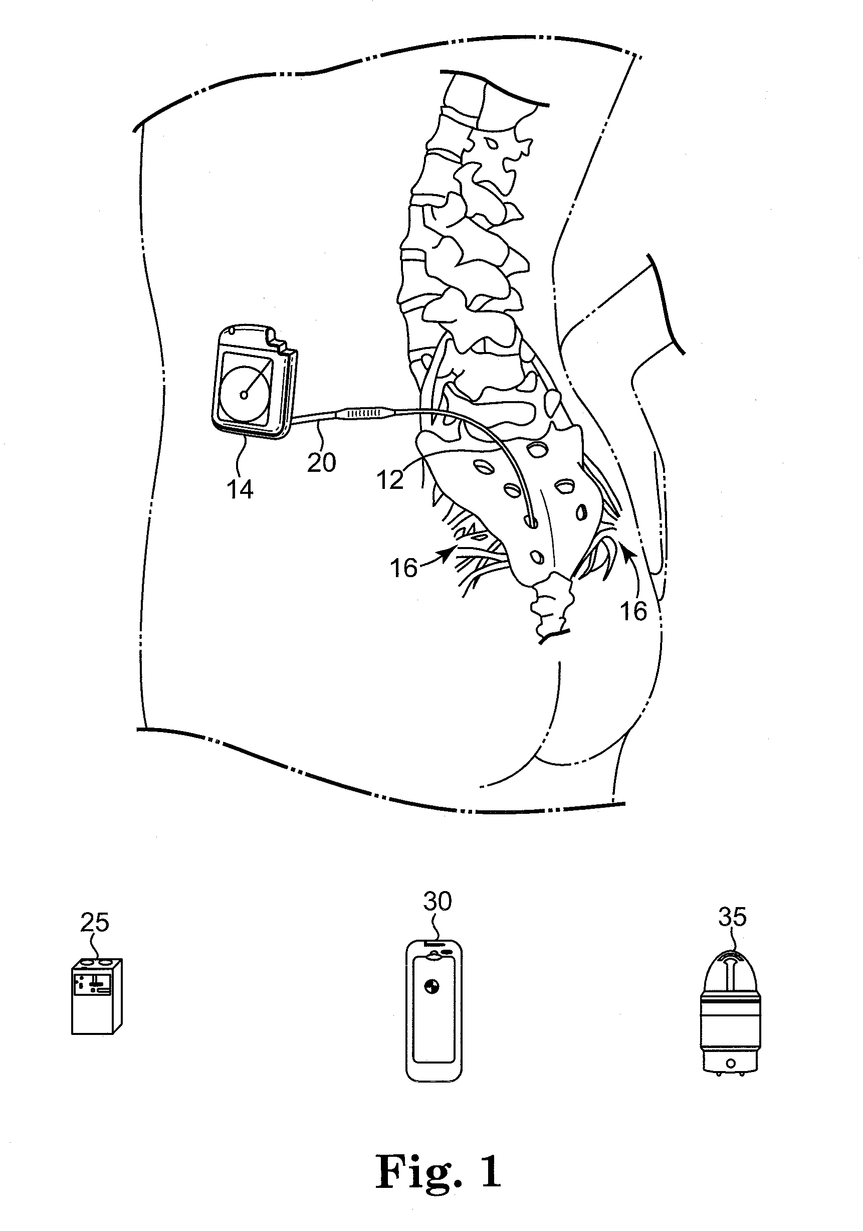 Voltage/current regulator improvements for an implantable medical device