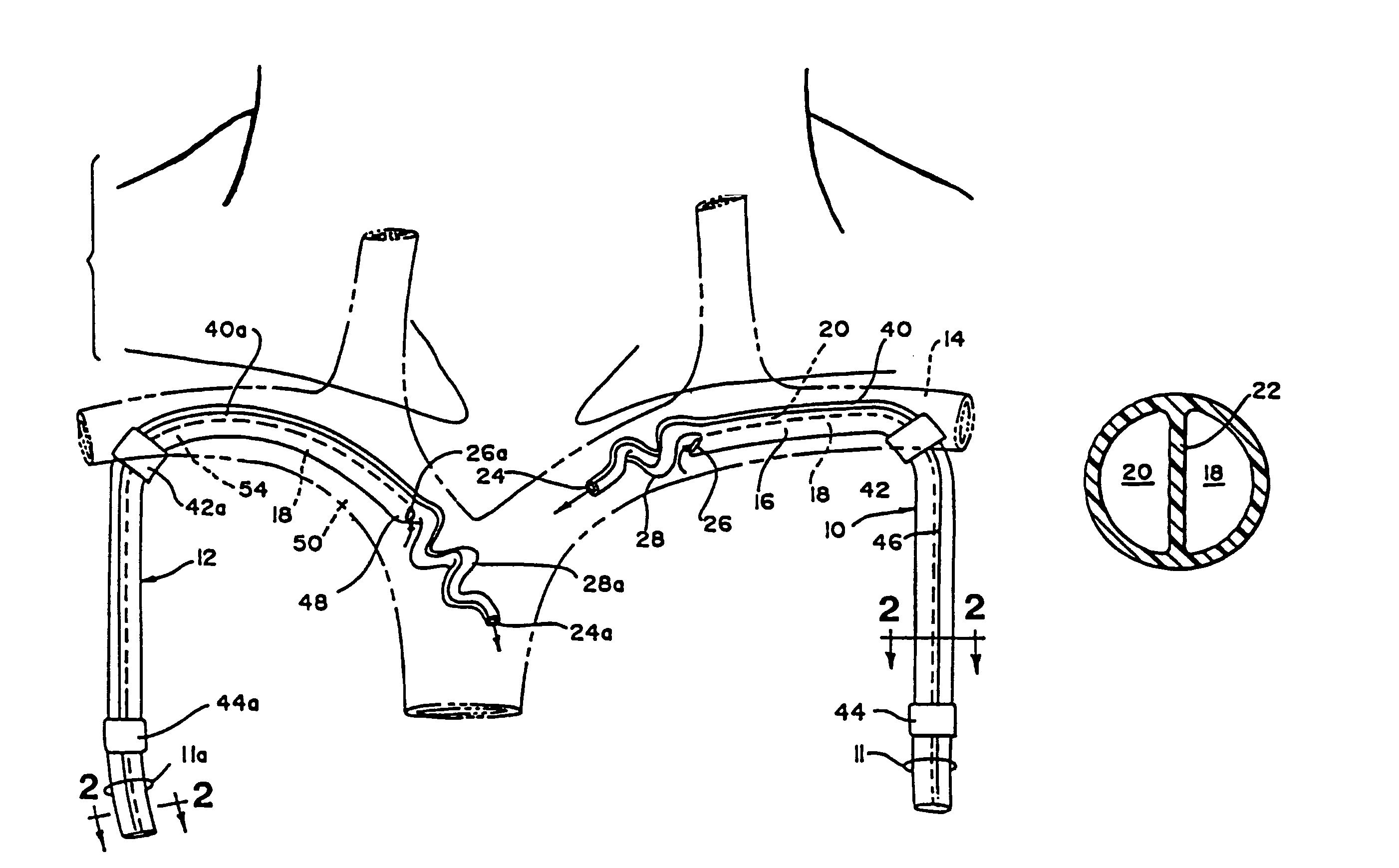 Multiple lumen catheter for hemodialysis