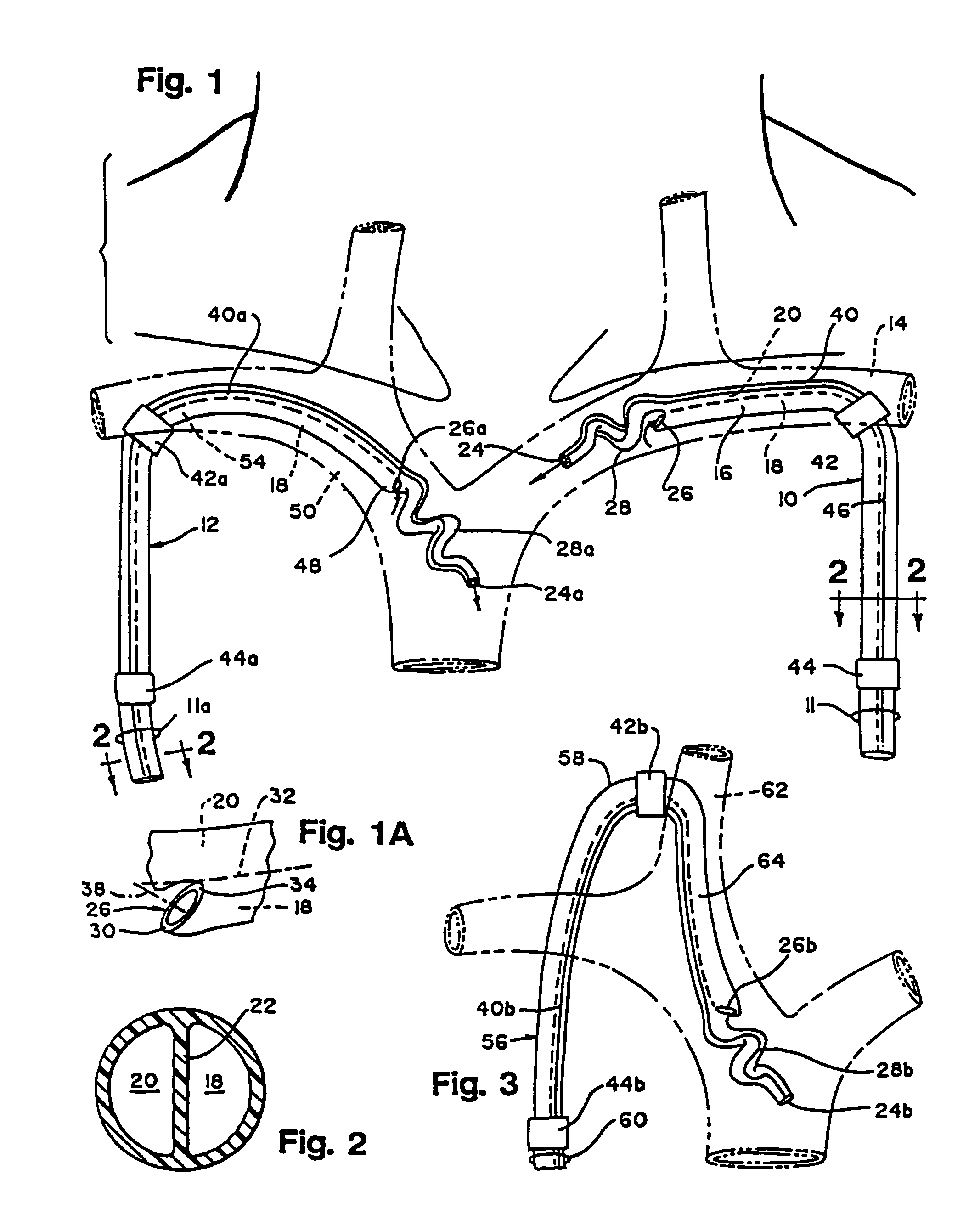 Multiple lumen catheter for hemodialysis