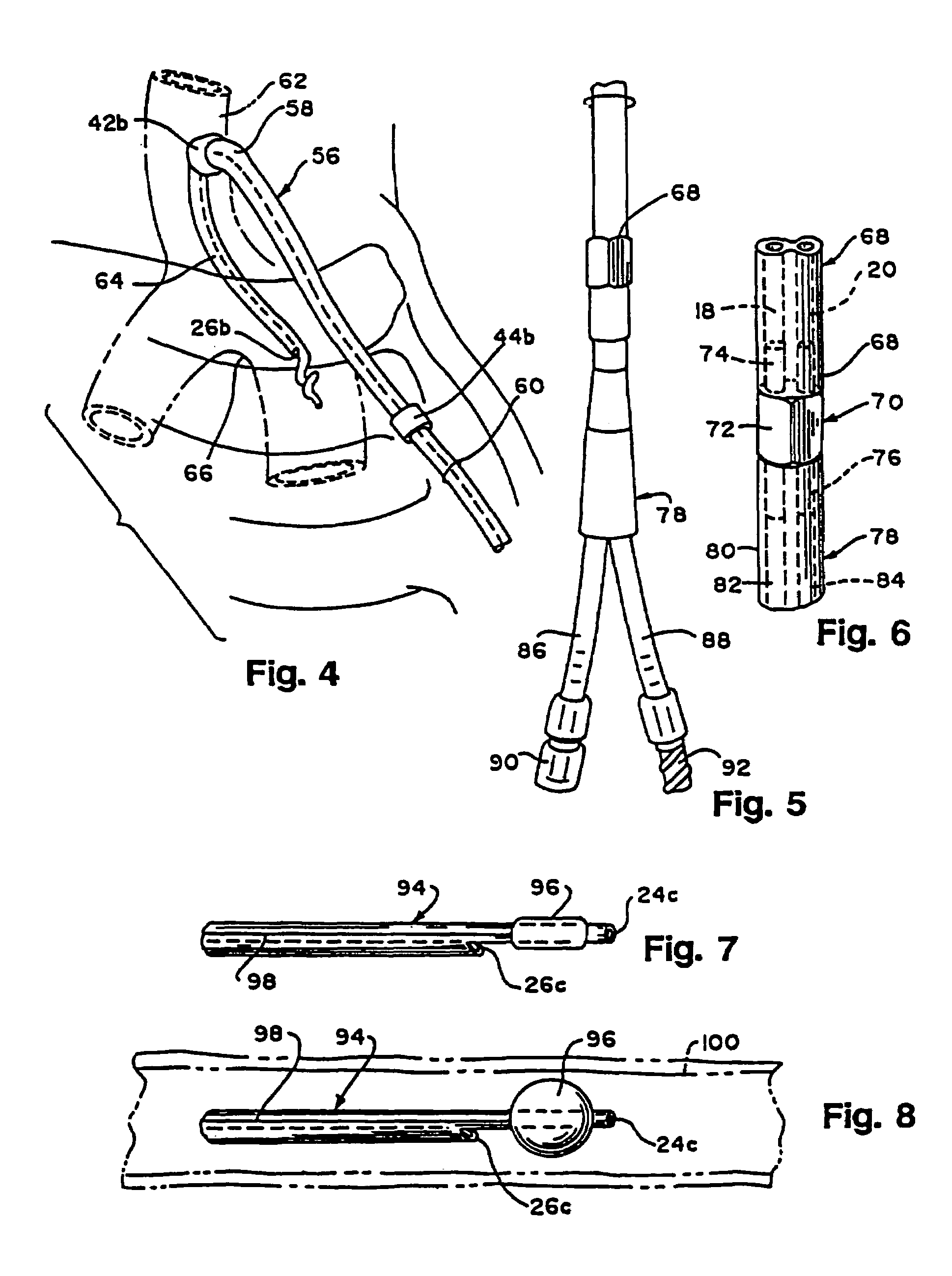 Multiple lumen catheter for hemodialysis