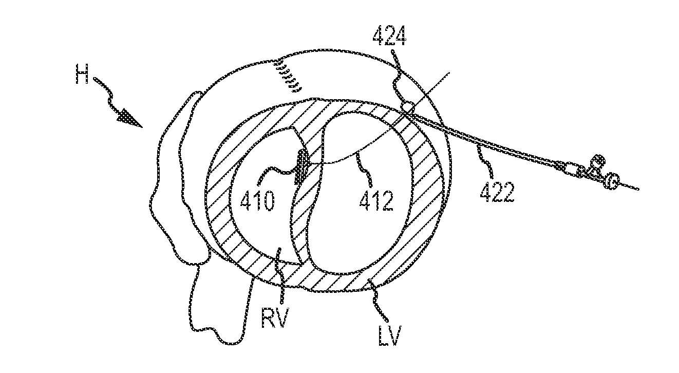 Cardiac tissue anchoring devices, methods, and systems for treatment of congestive heart failure and other conditions