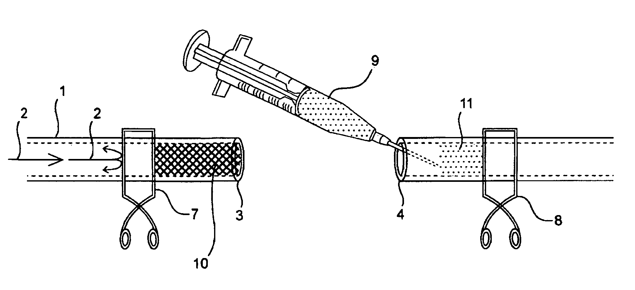 Compositions and methods for joining non-conjoined lumens