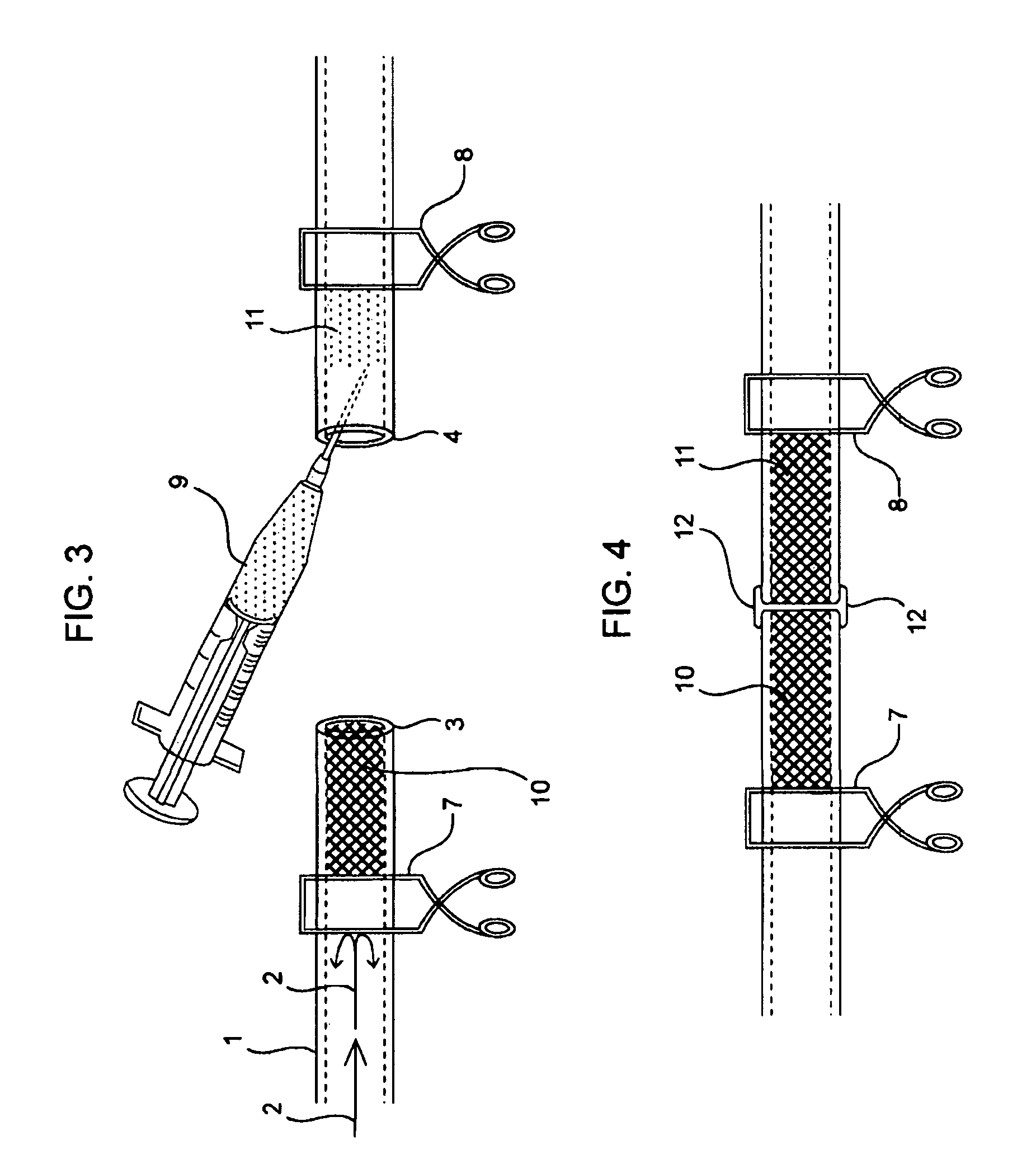 Compositions and methods for joining non-conjoined lumens