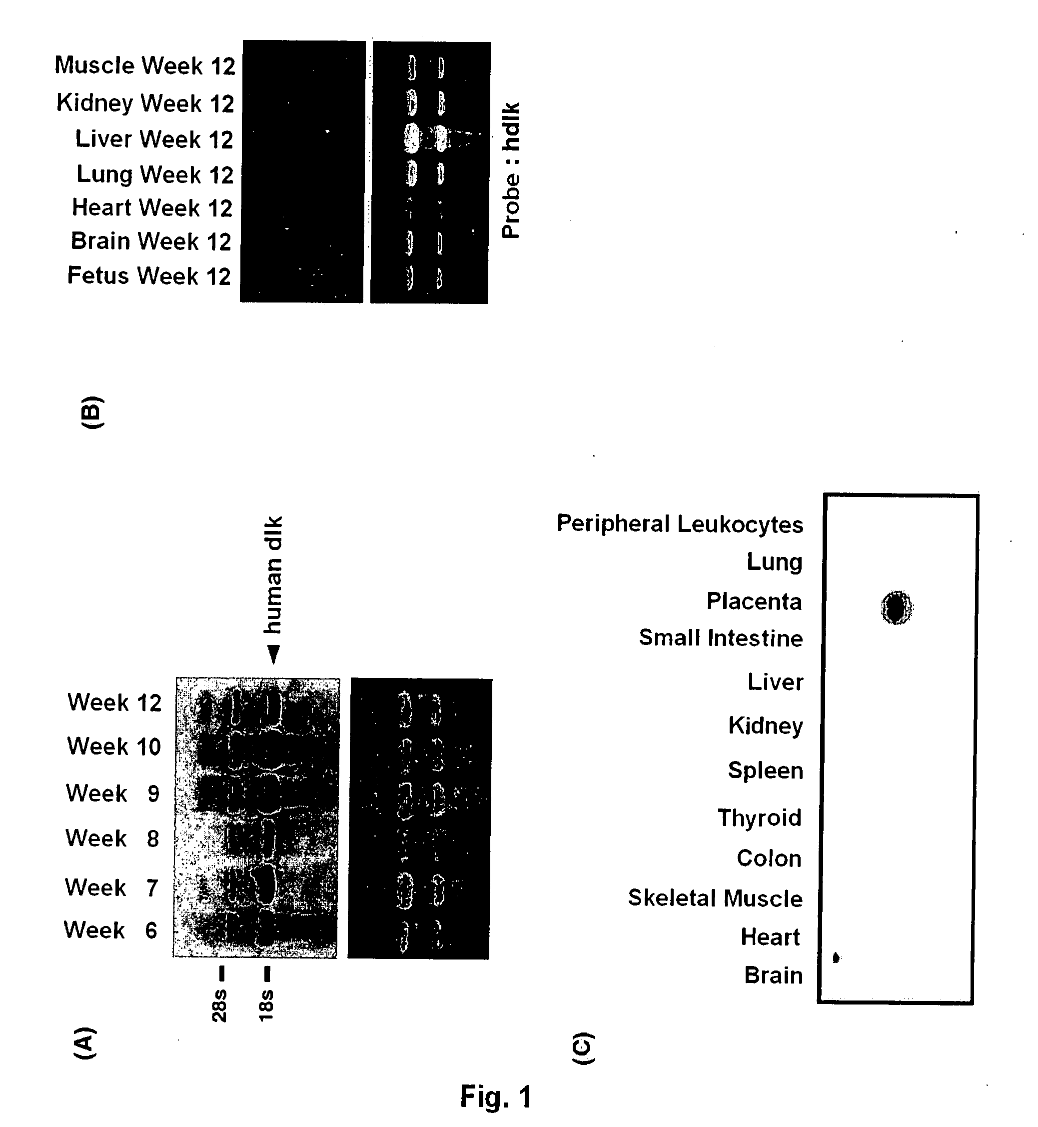 Method of Detecting Liver Cancer, Diagnostic for Liver Cancer and Remedy for Cancer