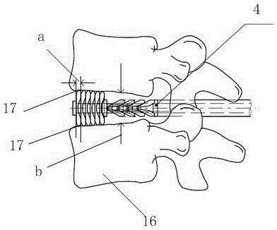 A formatted contact-adaptive full-support intervertebral fusion device