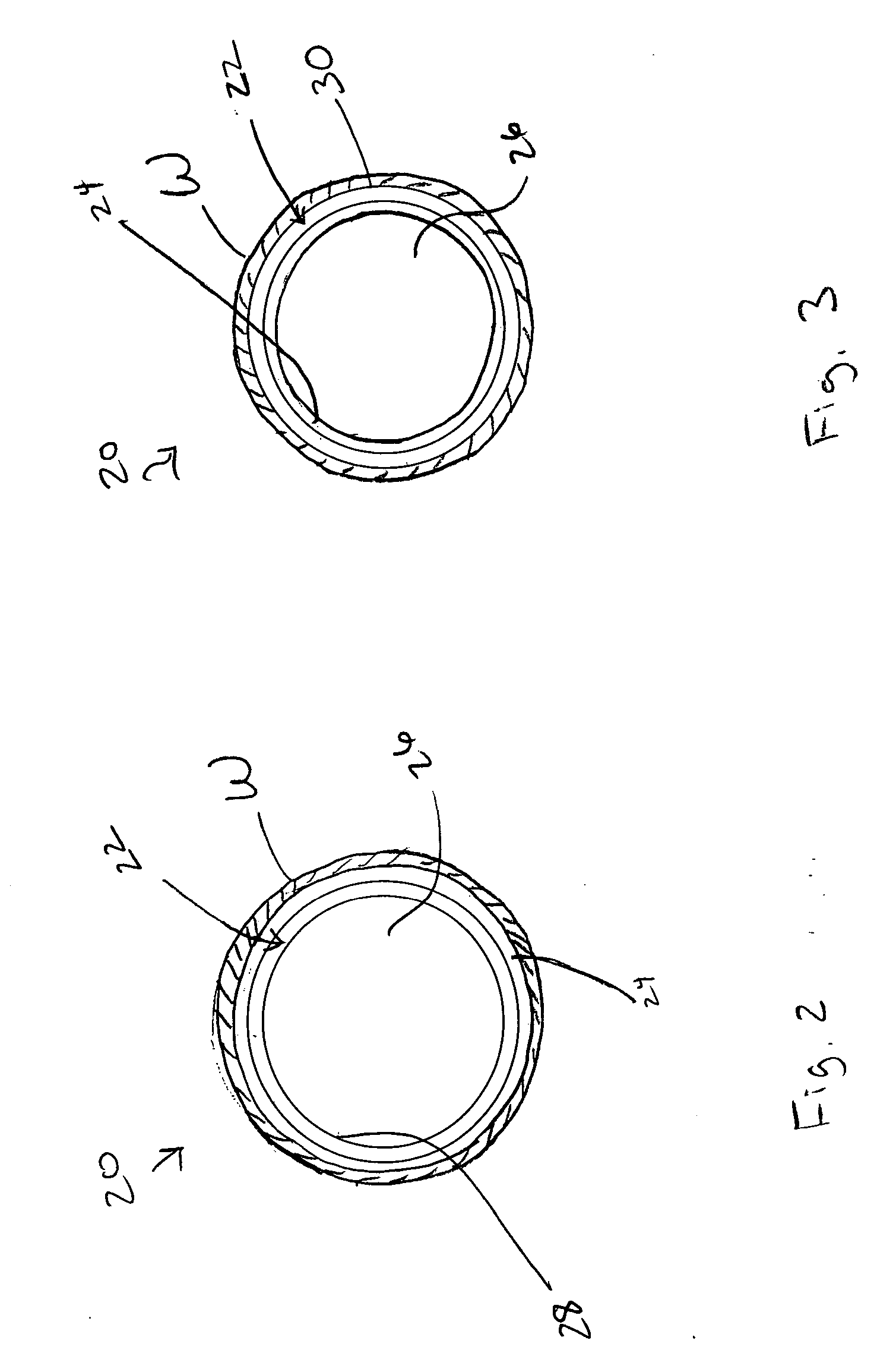 Bioabsorbable stent