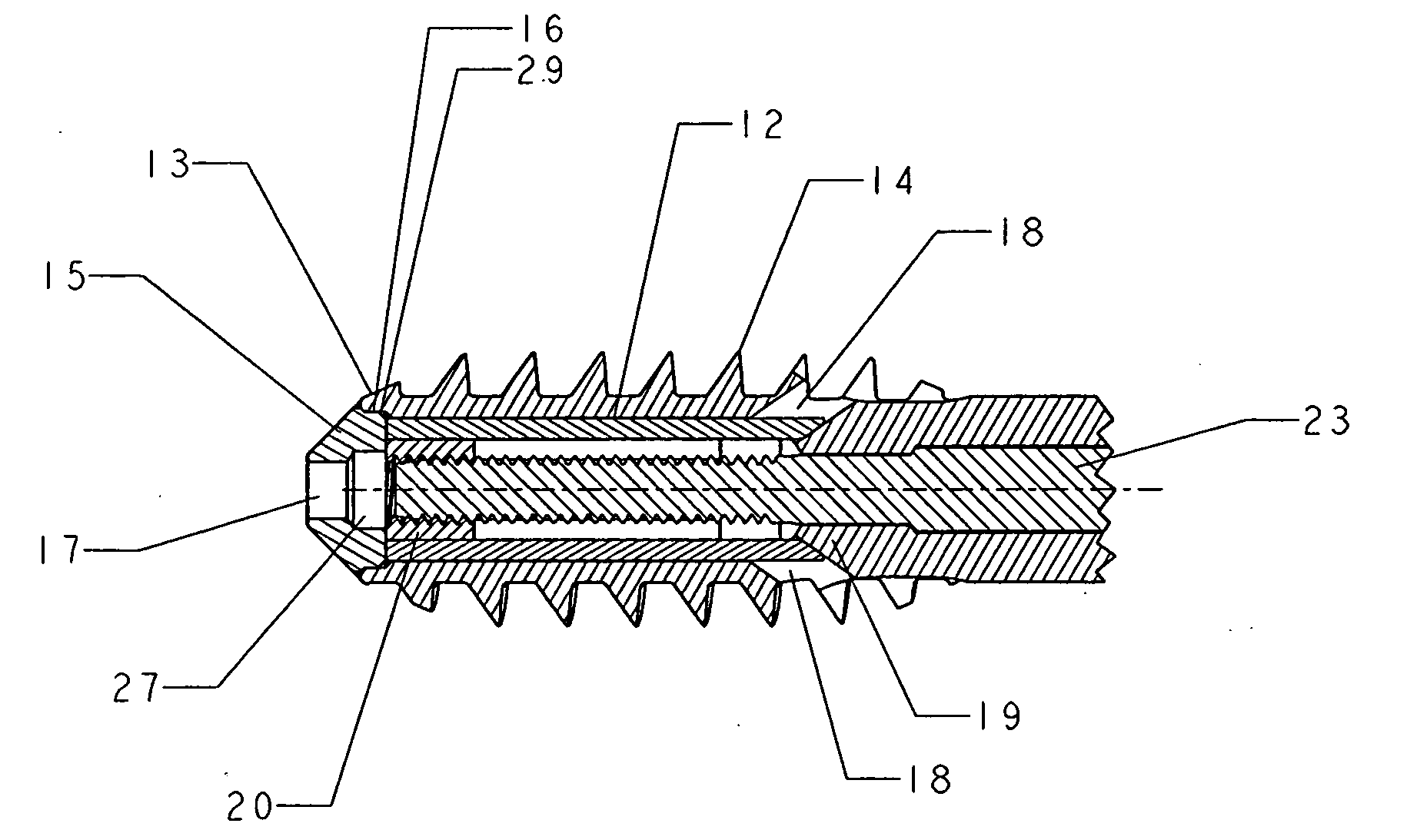 Intramedullary screw and tang for orthopedic surgery