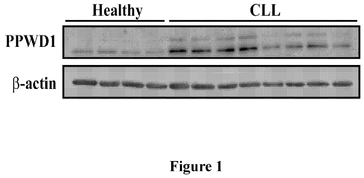 Biomarkers of chronic lymphocytic leukemia and use thereof