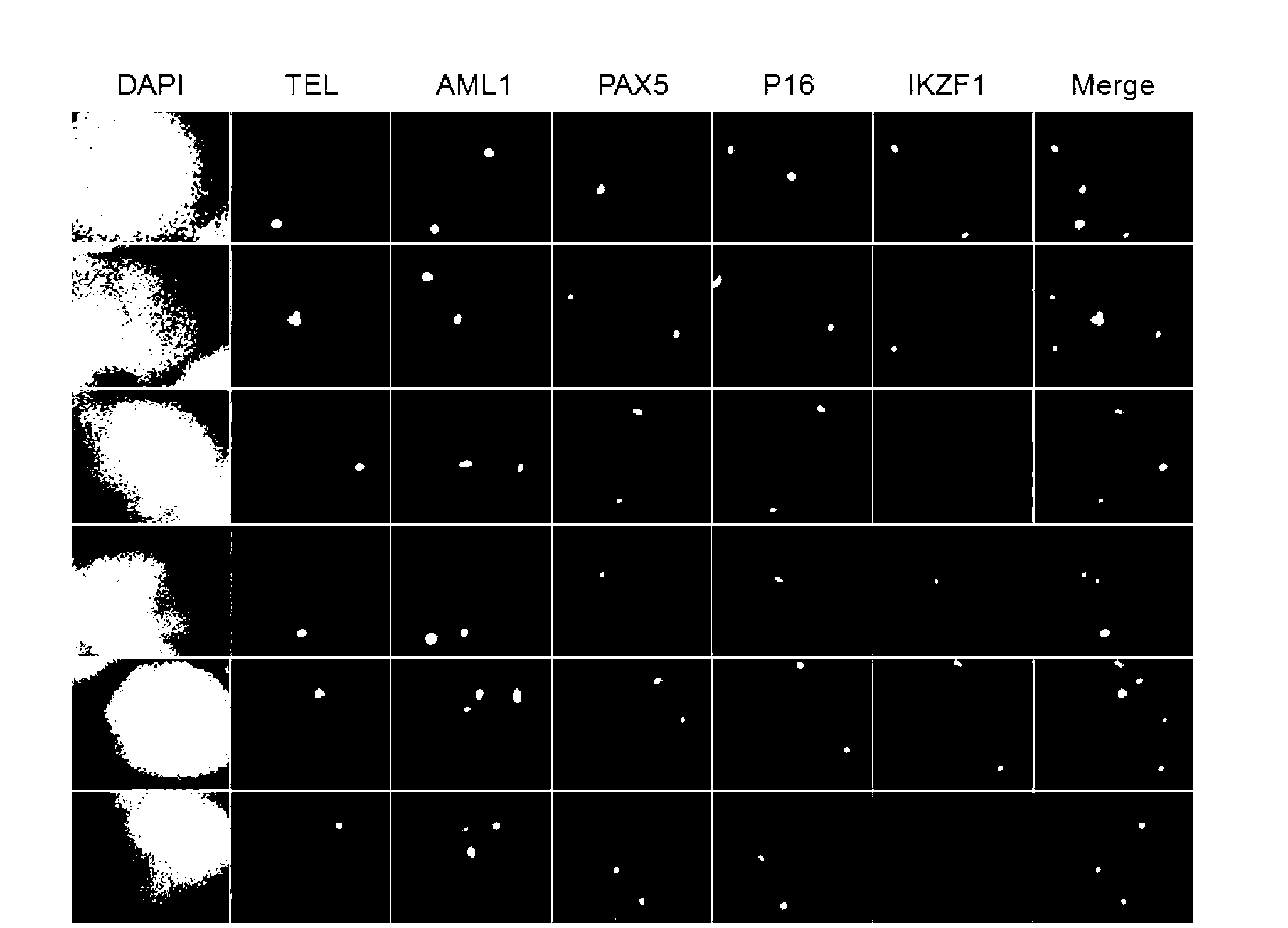 Gene probe composition and kit for acute lymphocytic leukemia detection