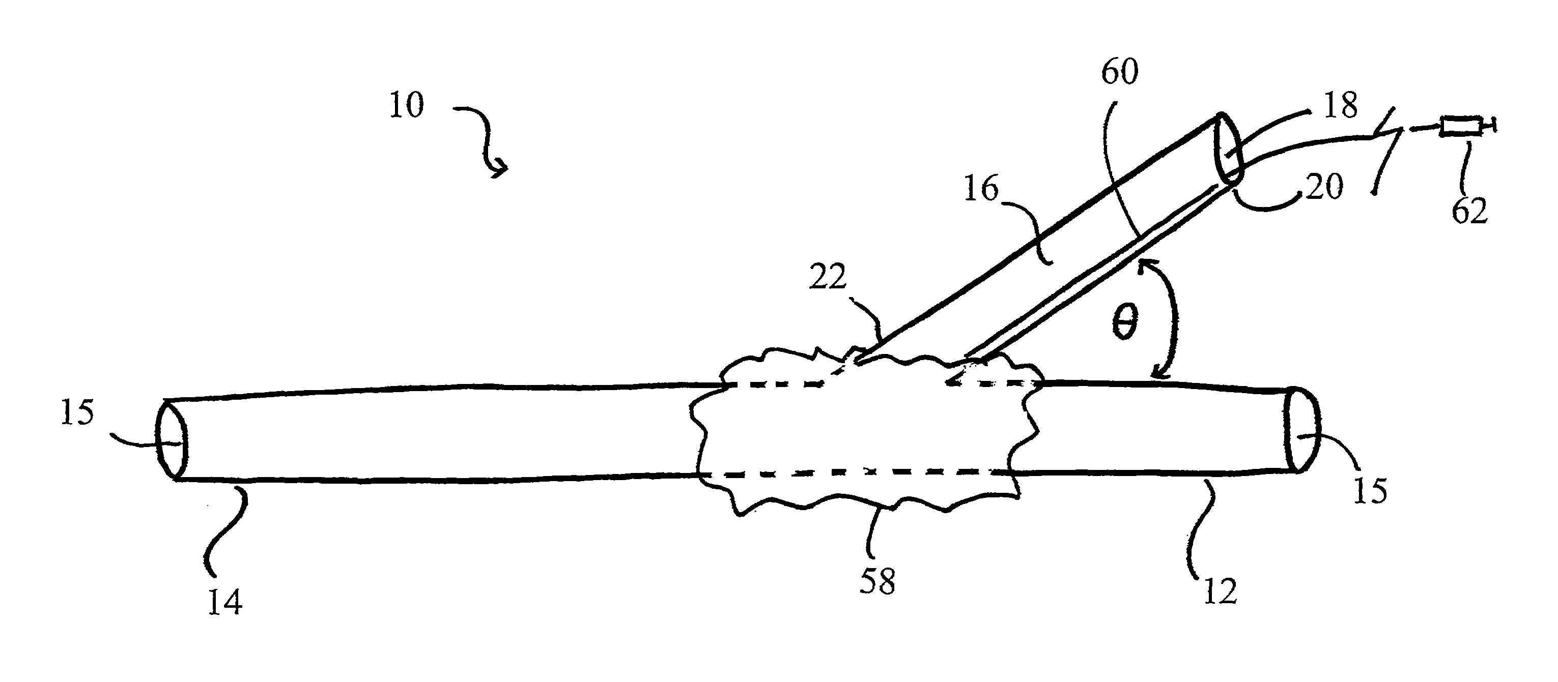 Autoretroperfusion devices and systems