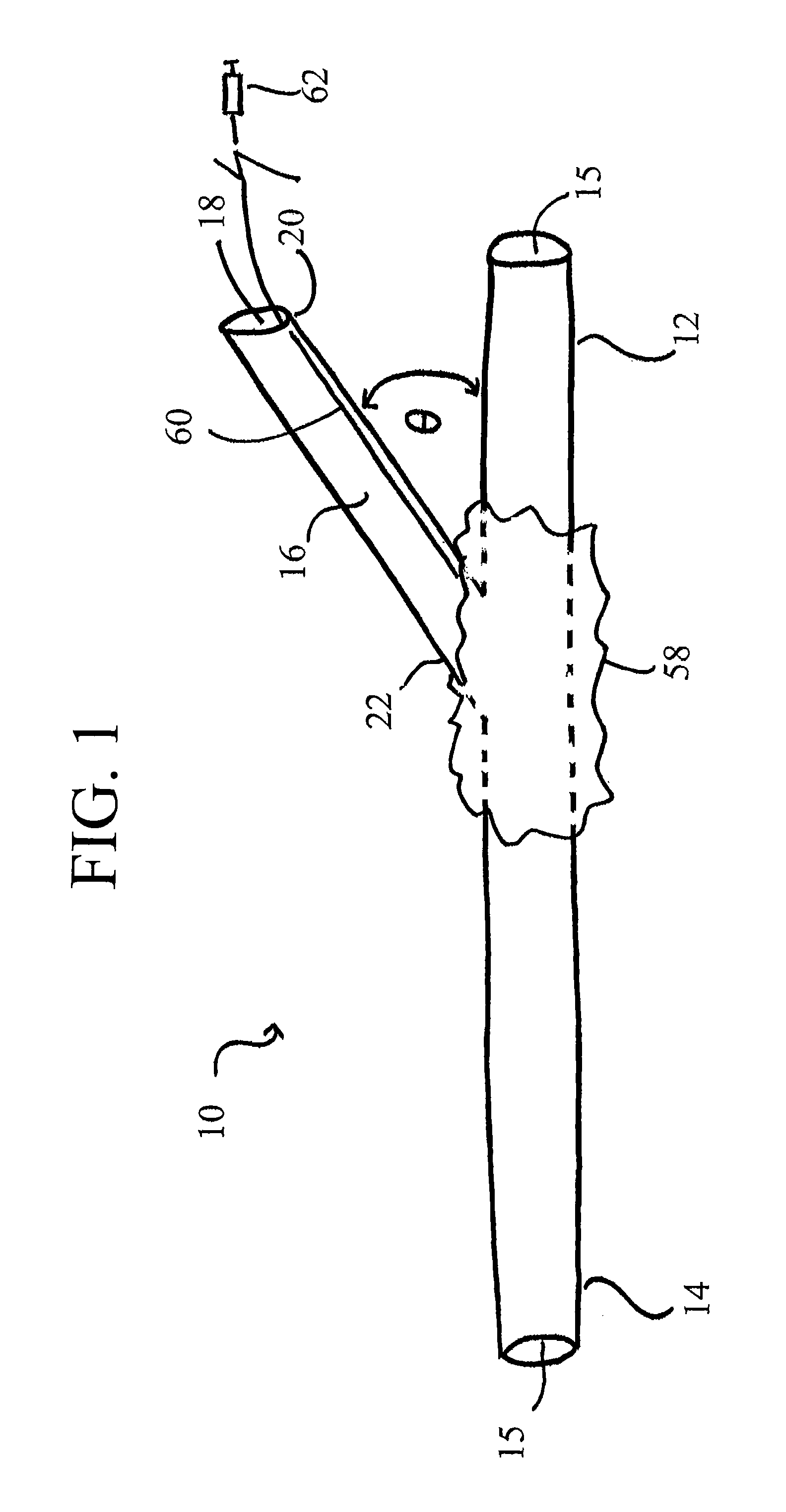 Autoretroperfusion devices and systems