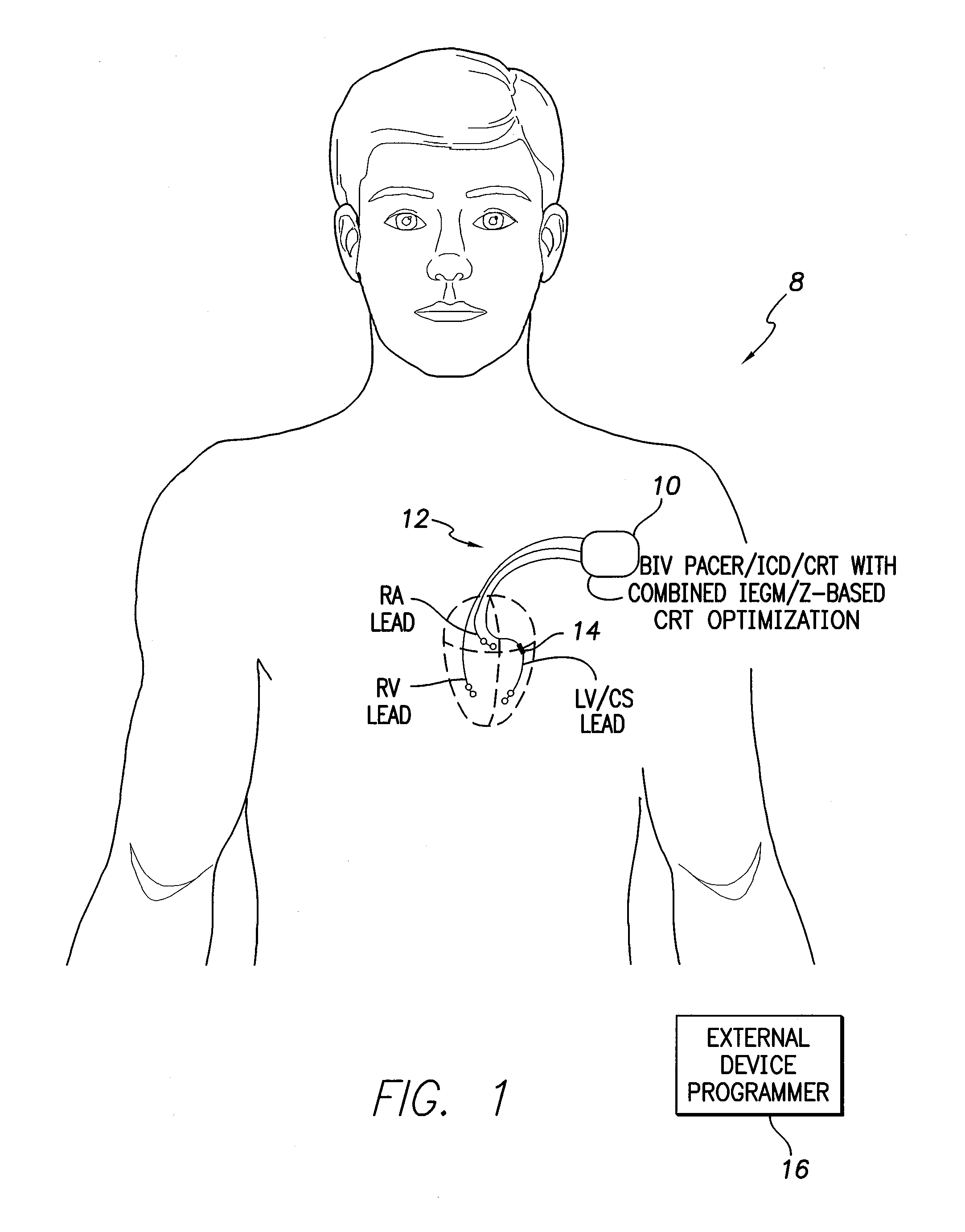 Systems and methods for optimizing AV/VV pacing delays using combined IEGM/impedance-based techniques for use with implantable medical devices