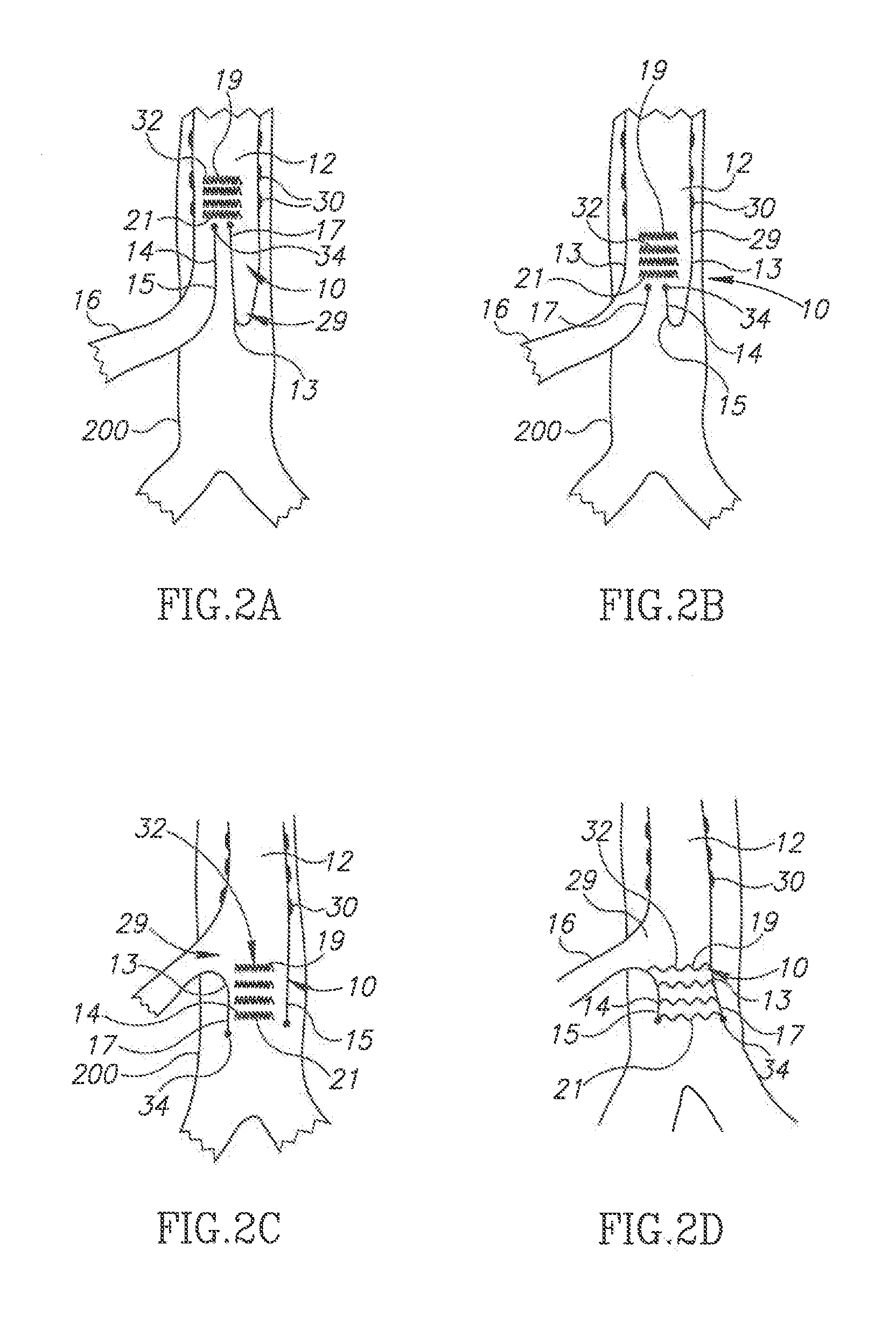 Bypass graft device and delivery system and method