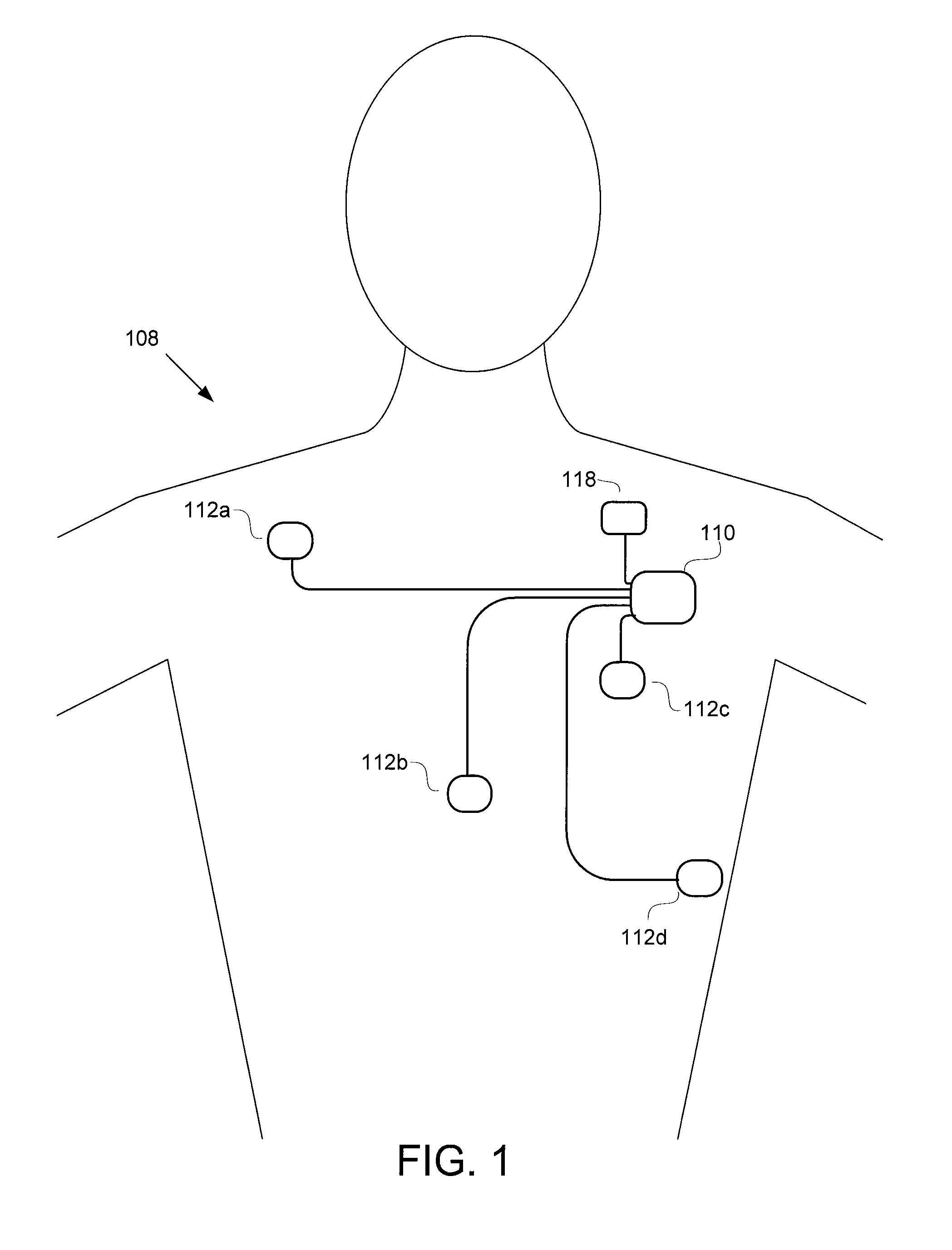 Systems and methods for detection of VT and VF from remote sensing electrodes