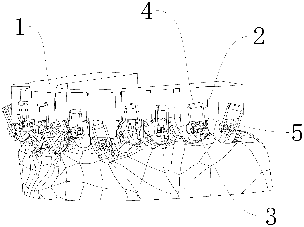 Method for direct bonding of orthodontic brackets