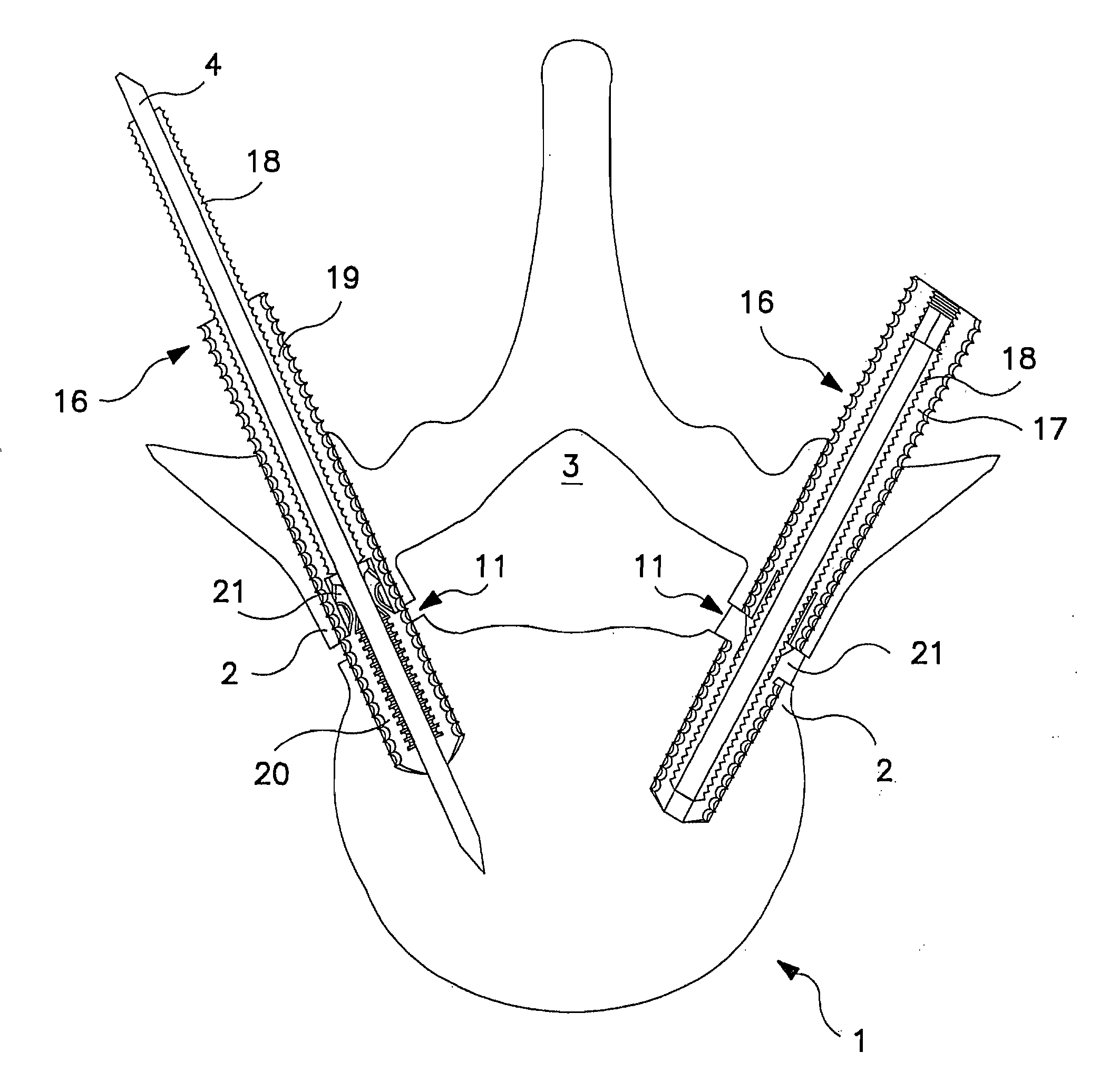 Percutaneous technique and implant for expanding the spinal canal