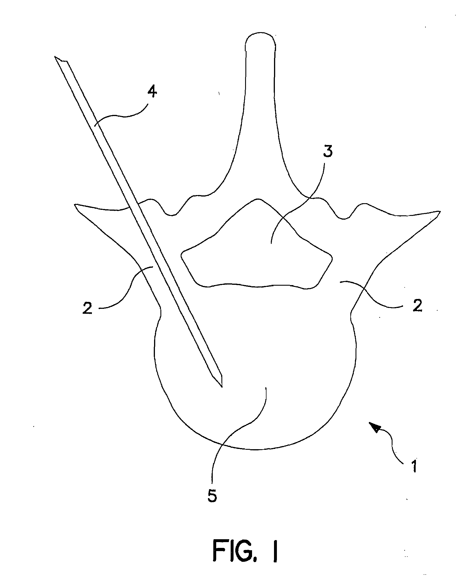 Percutaneous technique and implant for expanding the spinal canal