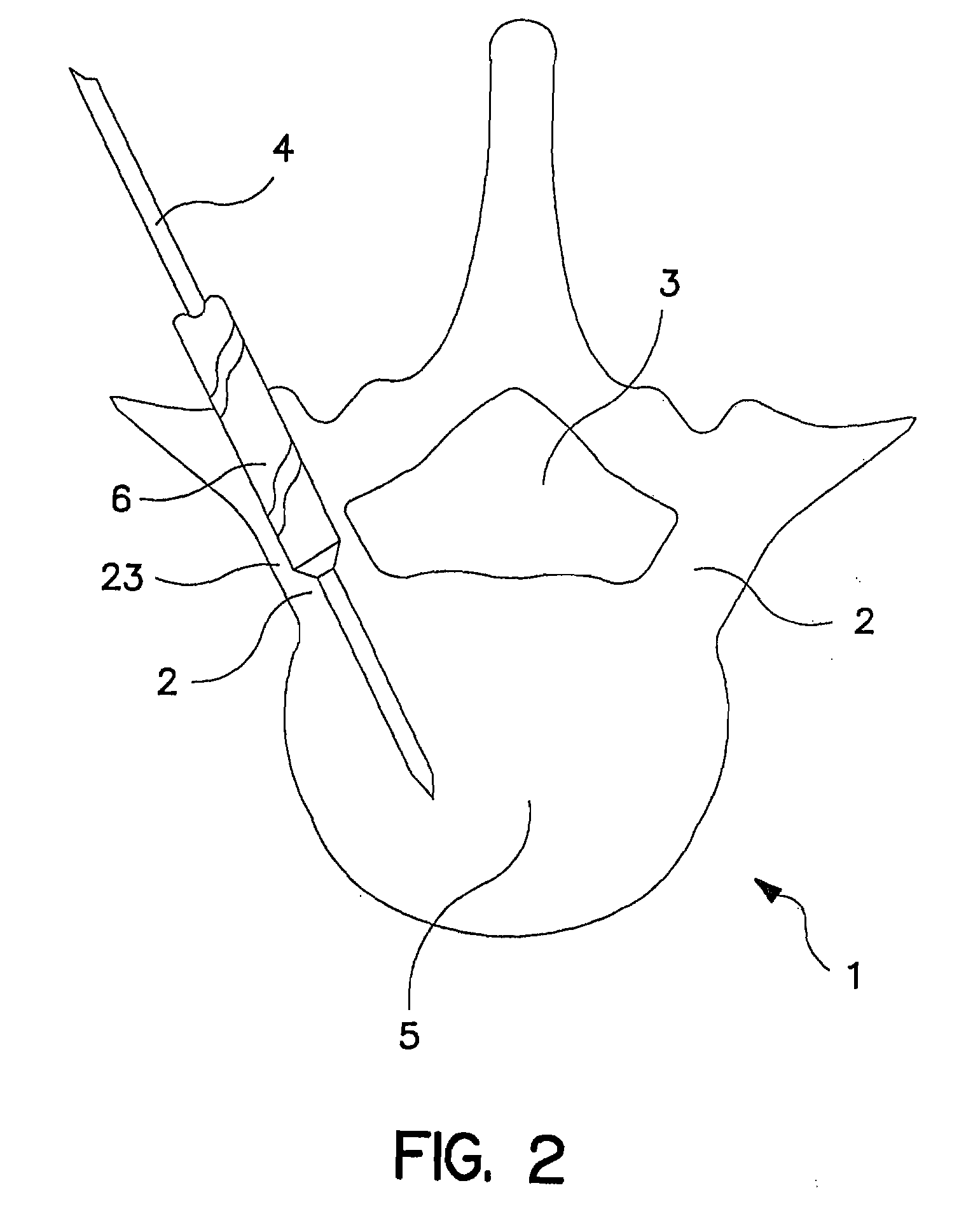 Percutaneous technique and implant for expanding the spinal canal