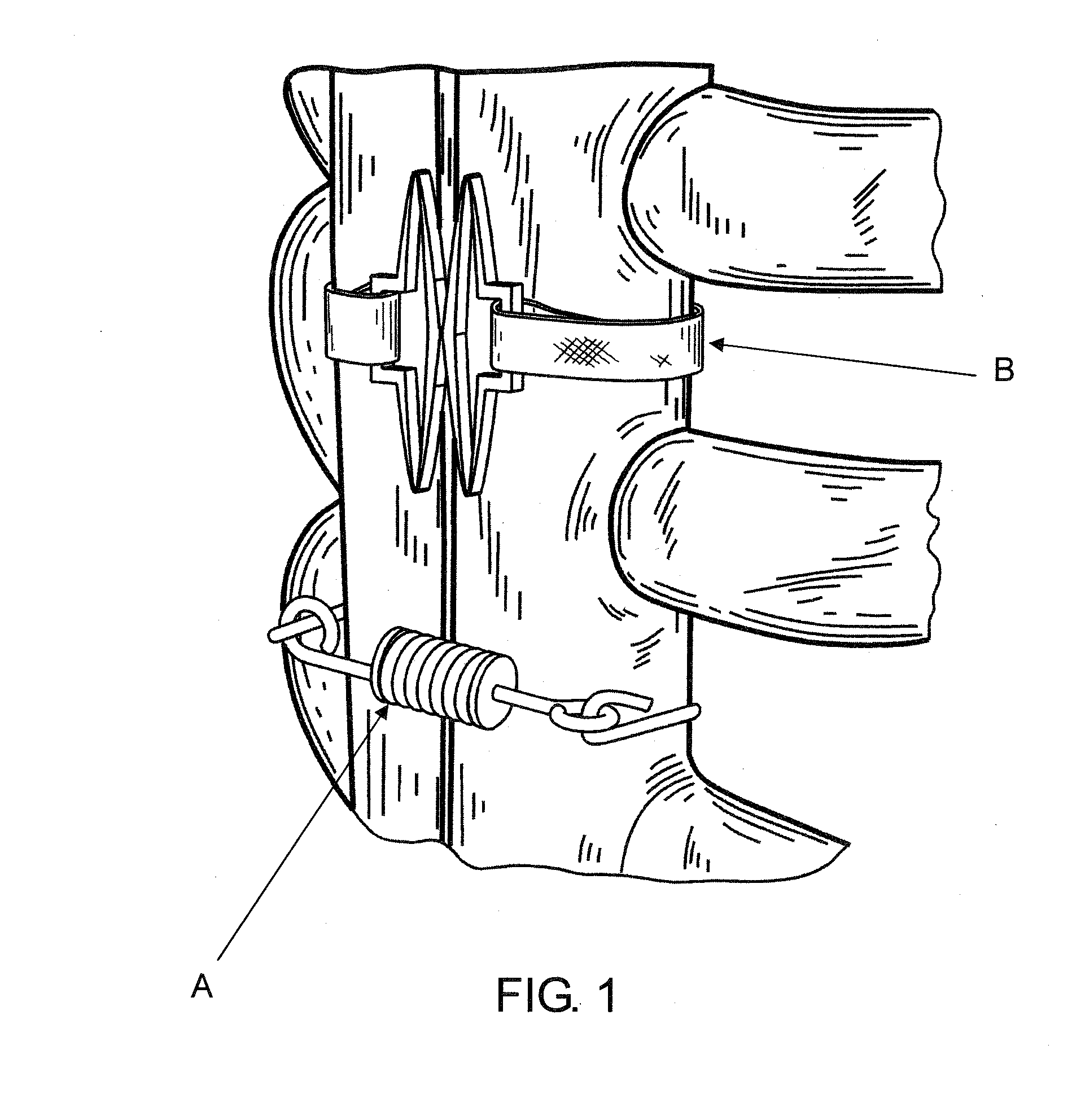 Flat suture banding system and methods