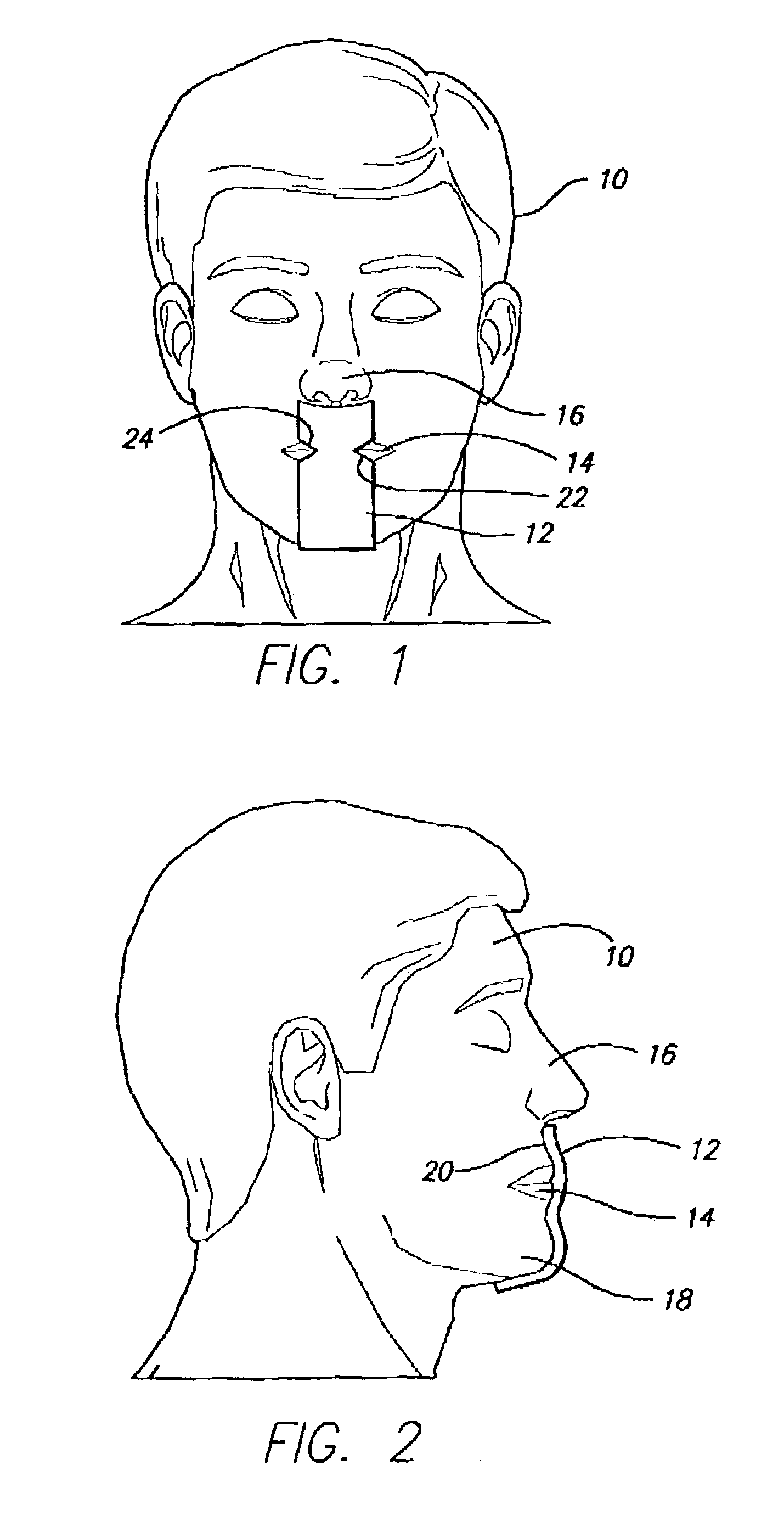 Snoreway space block with snore strips or portnoy buccal tab