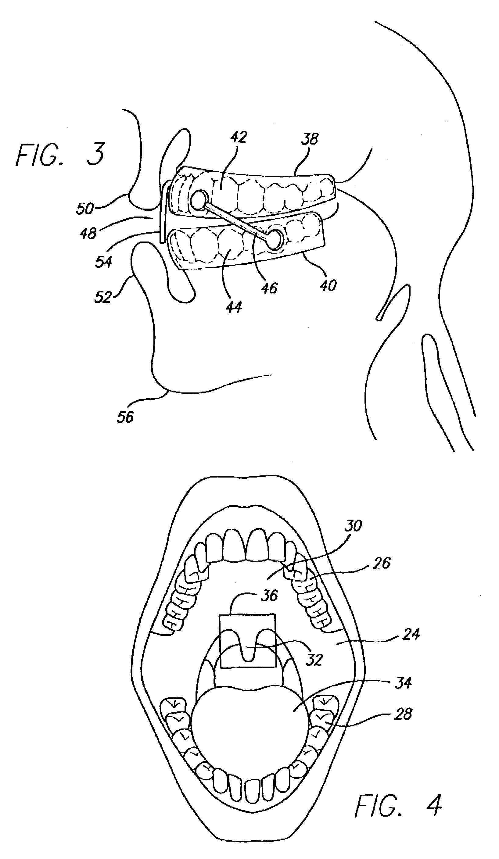 Snoreway space block with snore strips or portnoy buccal tab