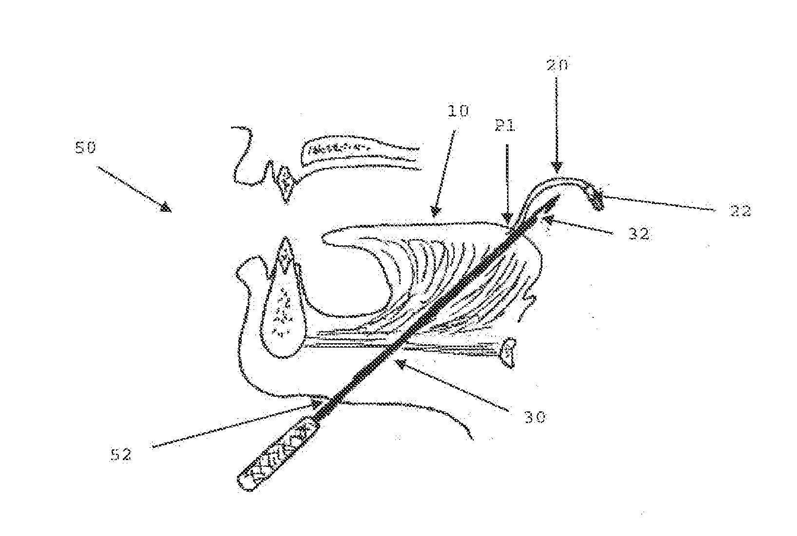 Modular Tissue Securement Systems