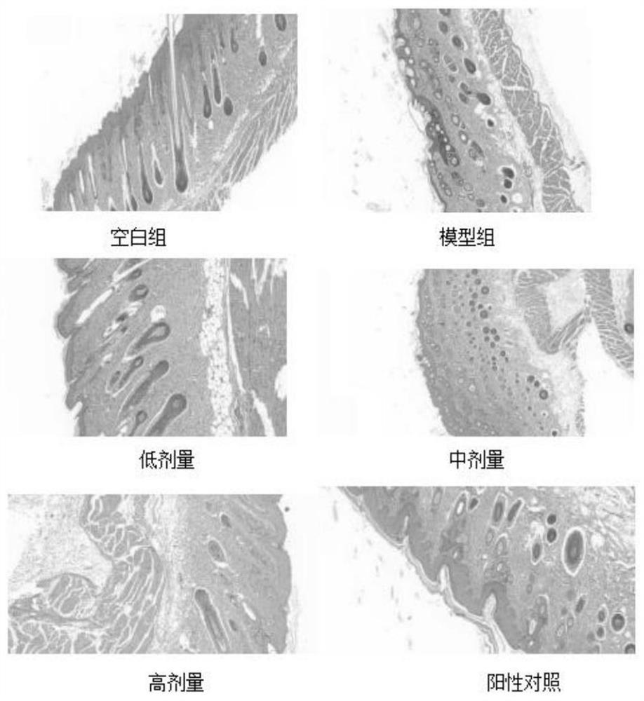 Traditional Chinese medicine leavening and application thereof in preparation of medicine for treating dermatosis caused by fungal infection