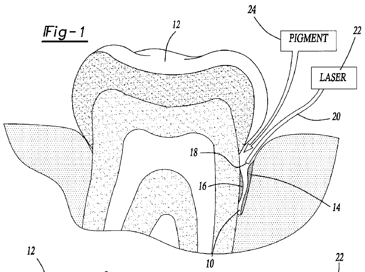 Method for treating periodontal disease