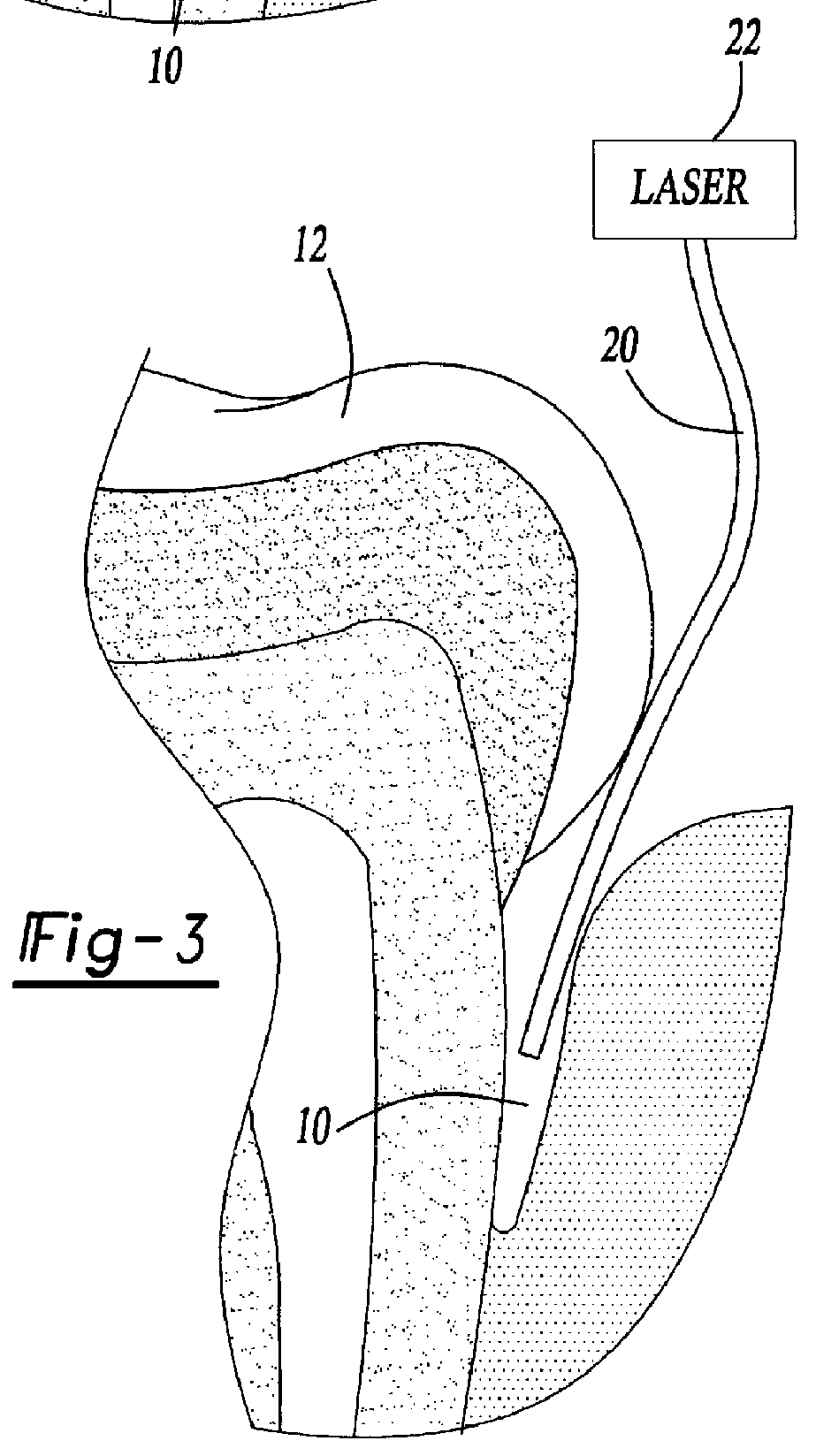 Method for treating periodontal disease