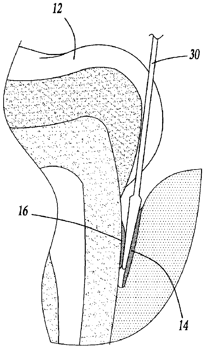 Method for treating periodontal disease