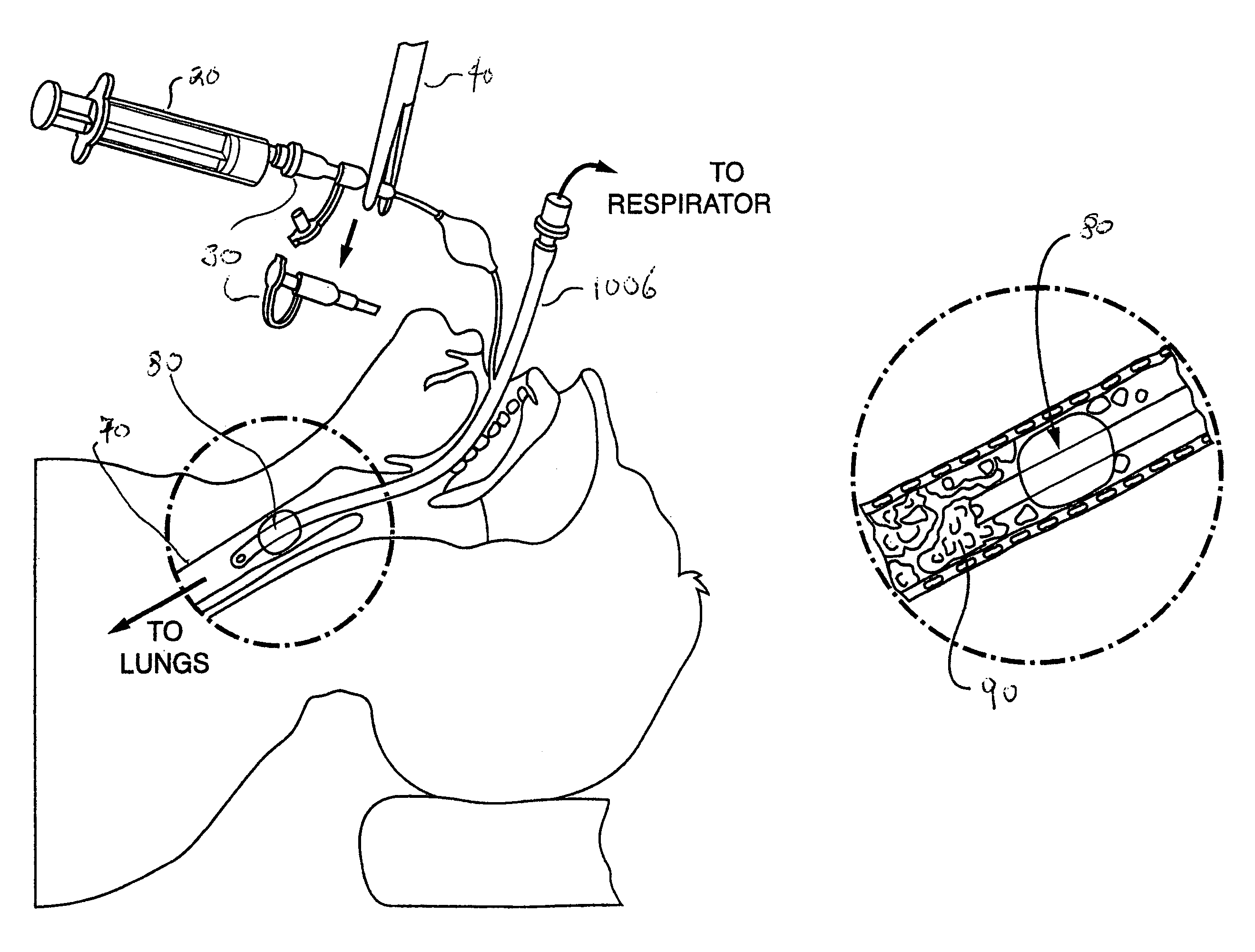 Methods, devices and formulations for targeted endobronchial therapy