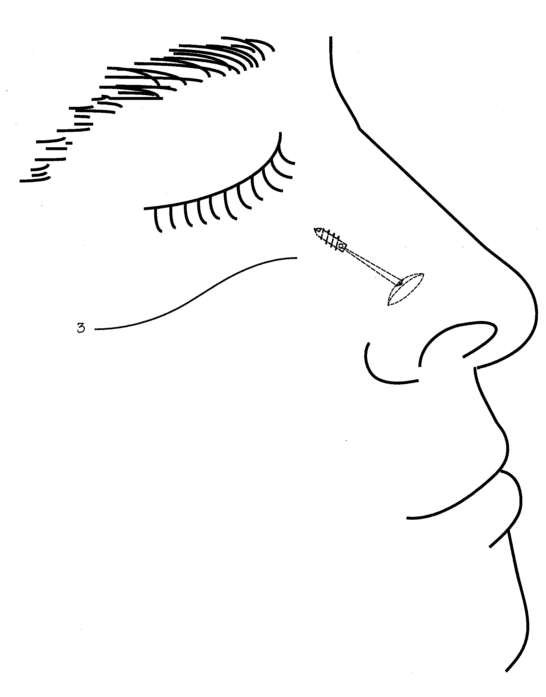 Device and Method for Nasal Surgery