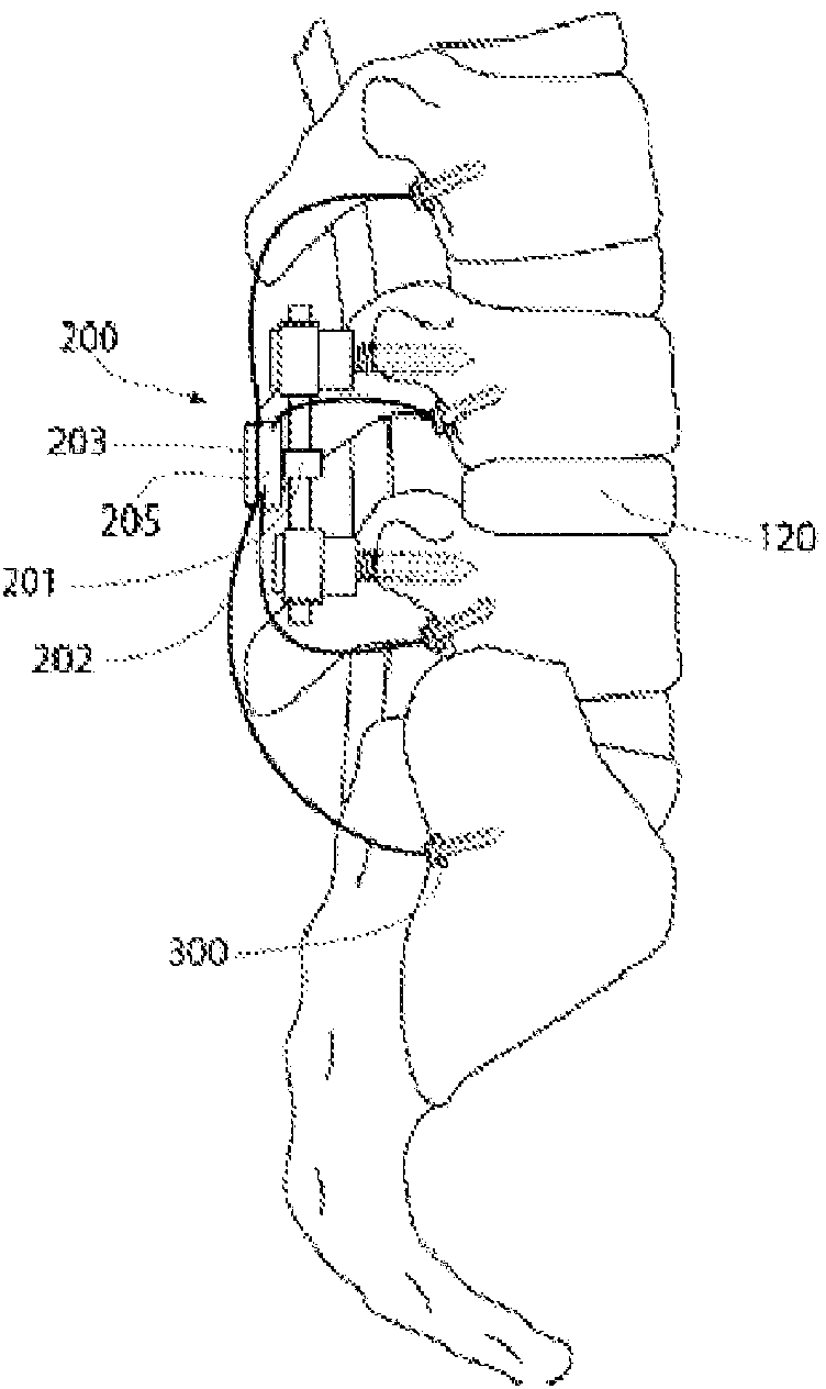 A method and apparatus for an implantable inertial-based sensing system for real-time, in vivo detection of spinal pseudarthrosis and adjacent segment motion