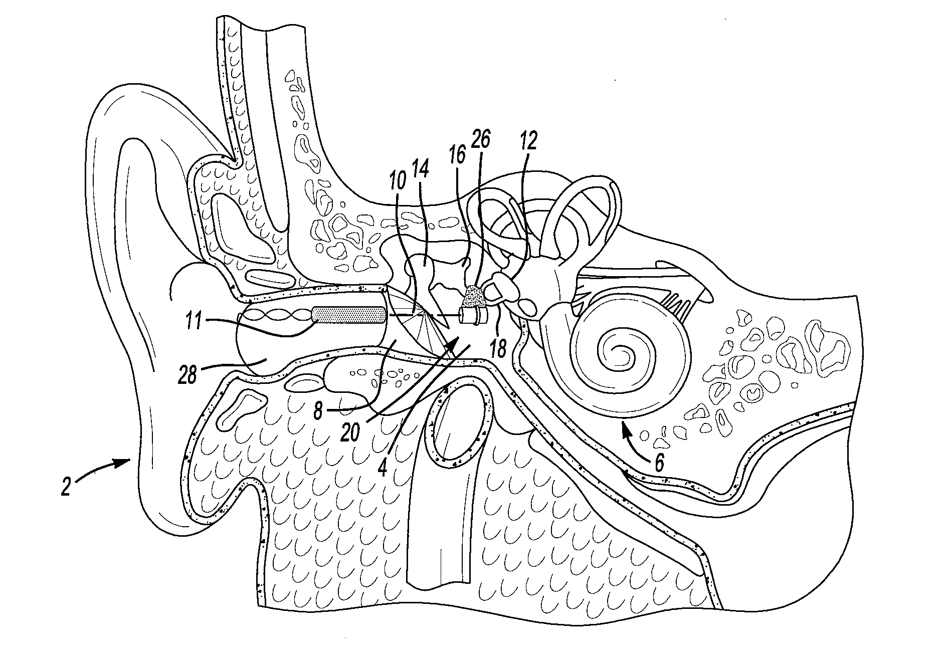 Middle ear implant and method