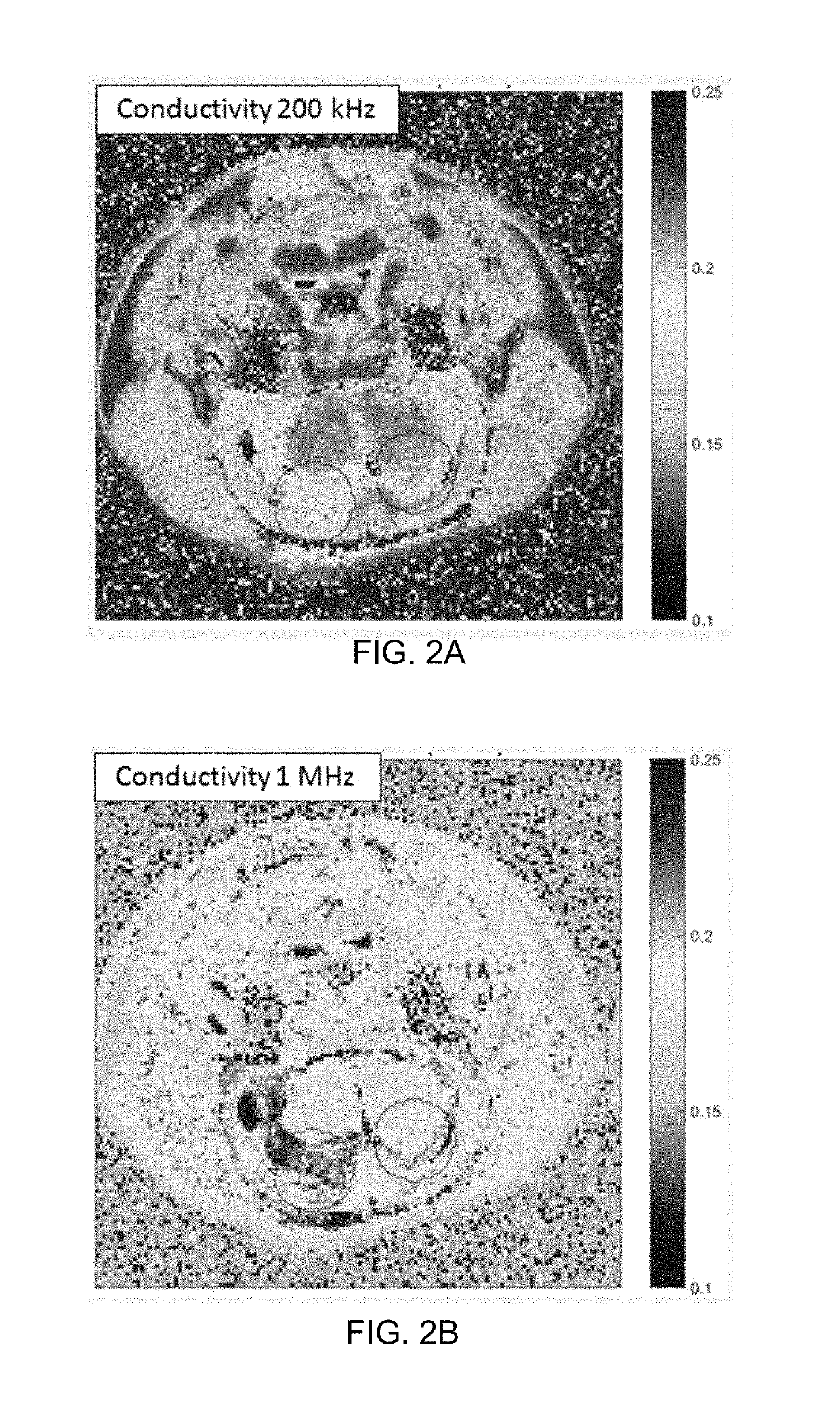 TTField Treatment with Optimization of Electrode Positions Based on Low Frequency (&#x3c;1MHZ) AC Conductivity Estimates Derived From Two MRI Images Having Different Repetition Times