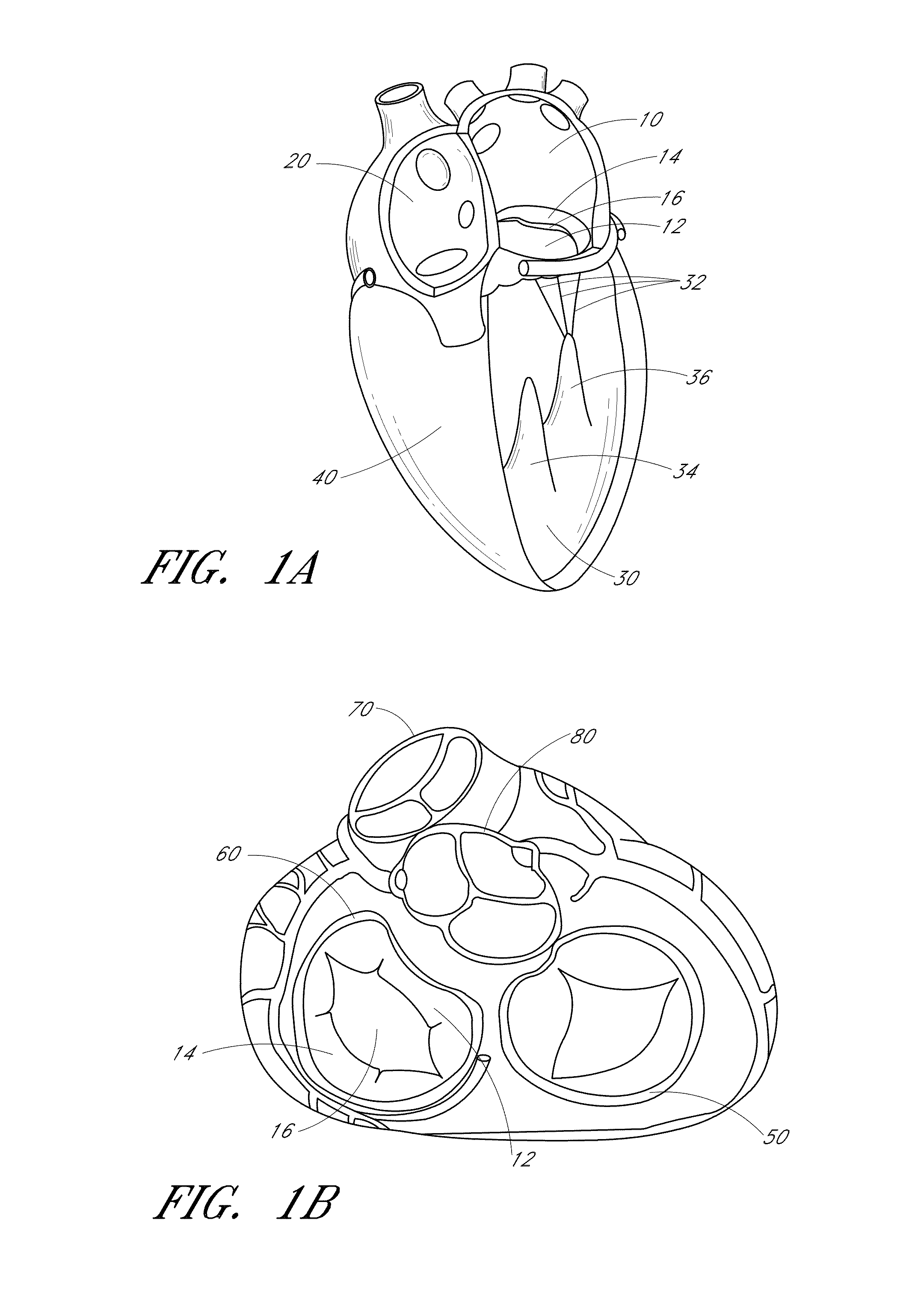 Device, system, and method for transcatheter treatment of valve regurgitation