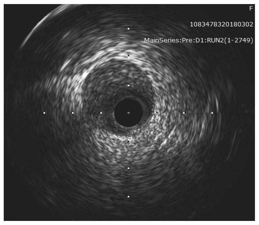 Method, device, system and computer storage medium for calculating blood flow reserve fraction based on intracavity images