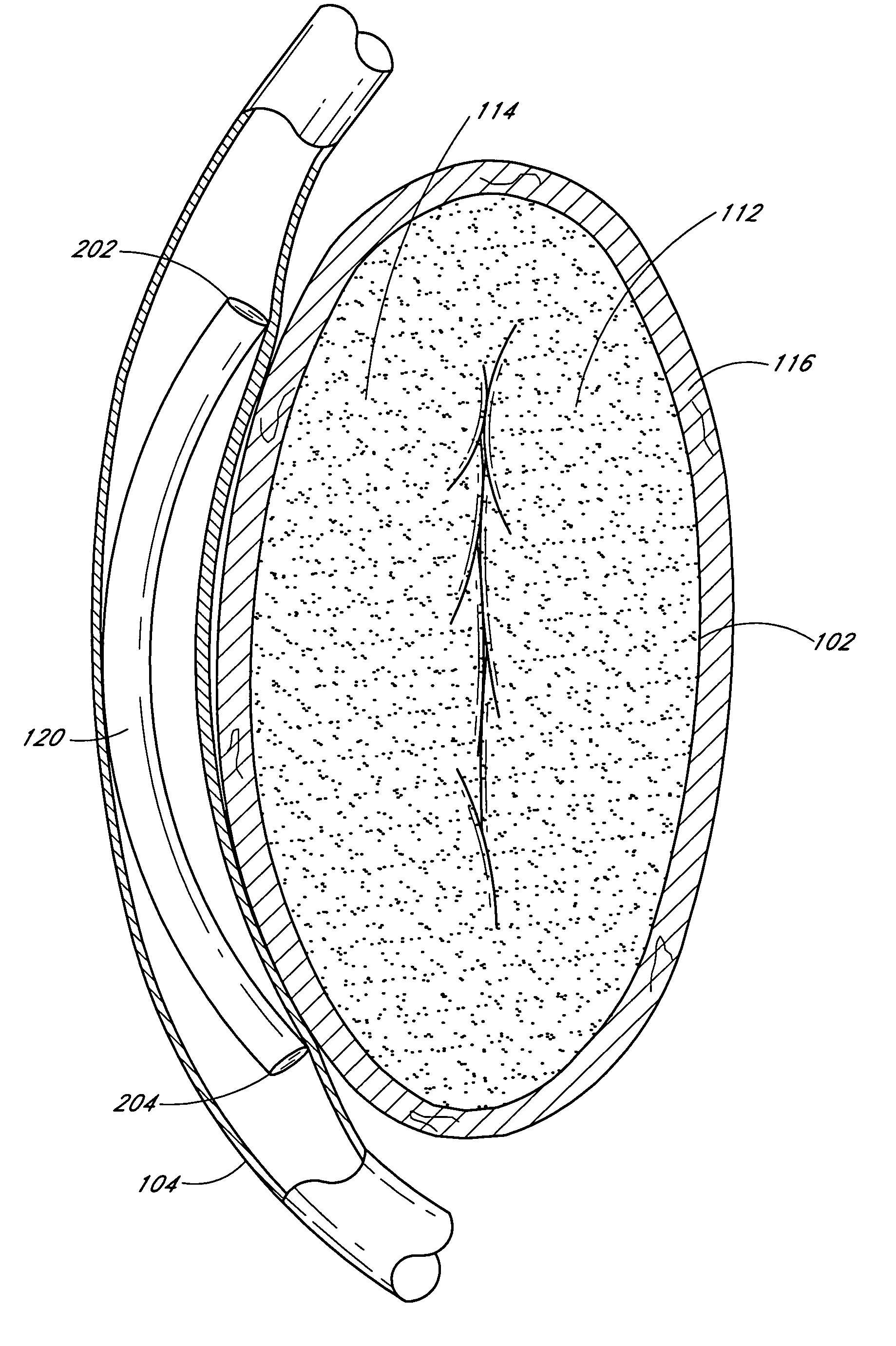 Dynamically adjustable implants and methods for reshaping tissue