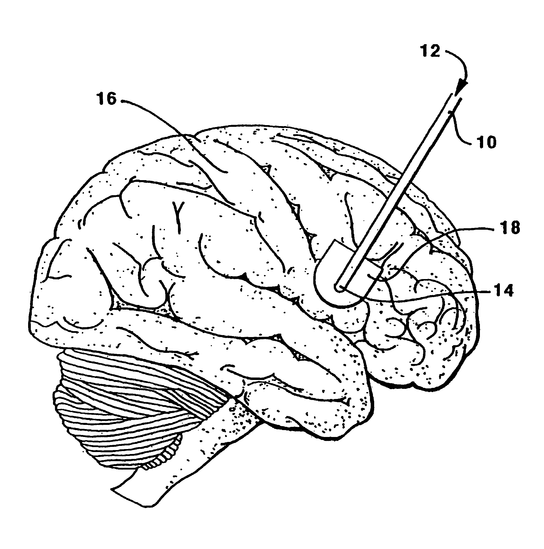 Therapeutic method of treatment of alzheimer's disease