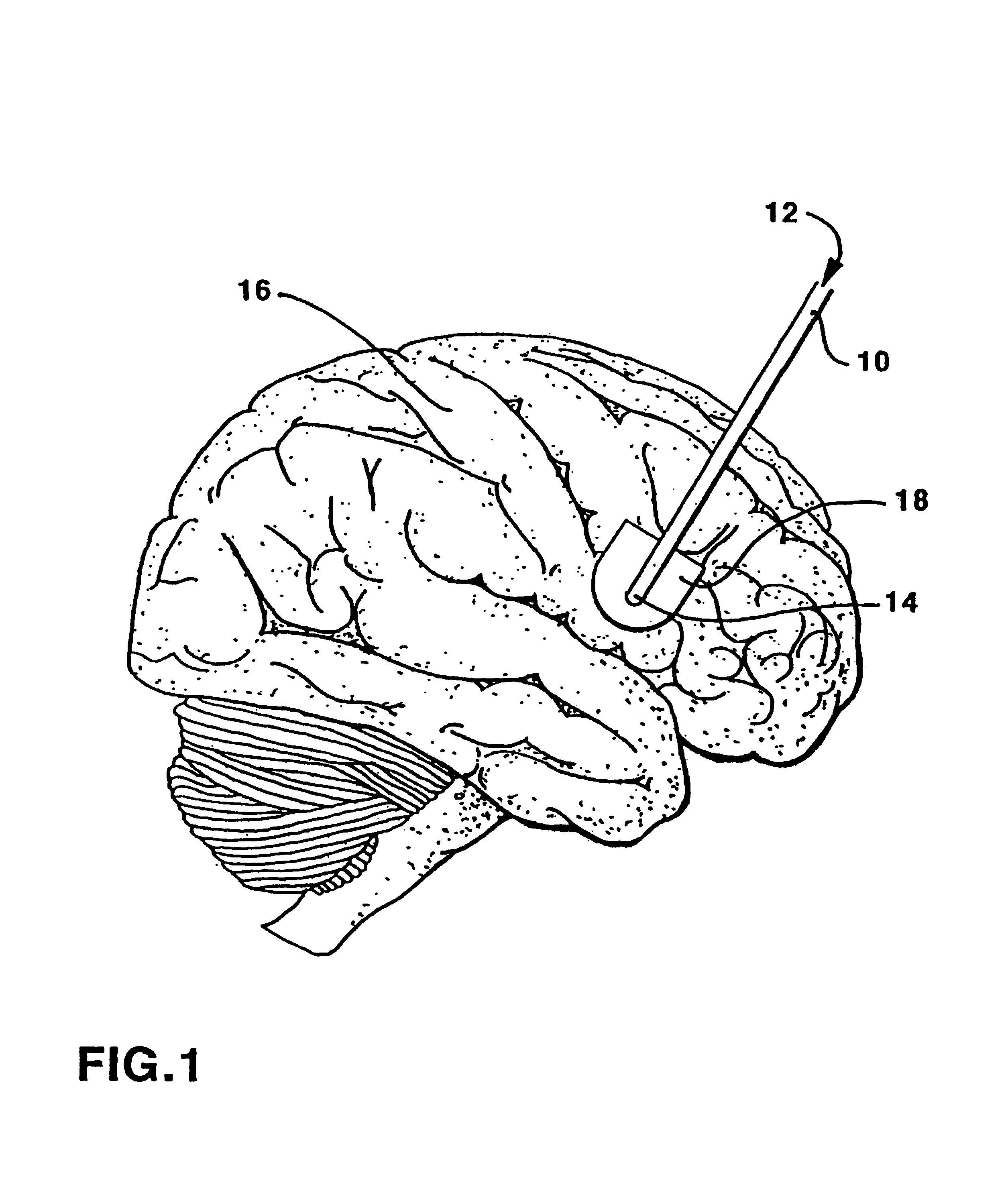 Therapeutic method of treatment of alzheimer's disease