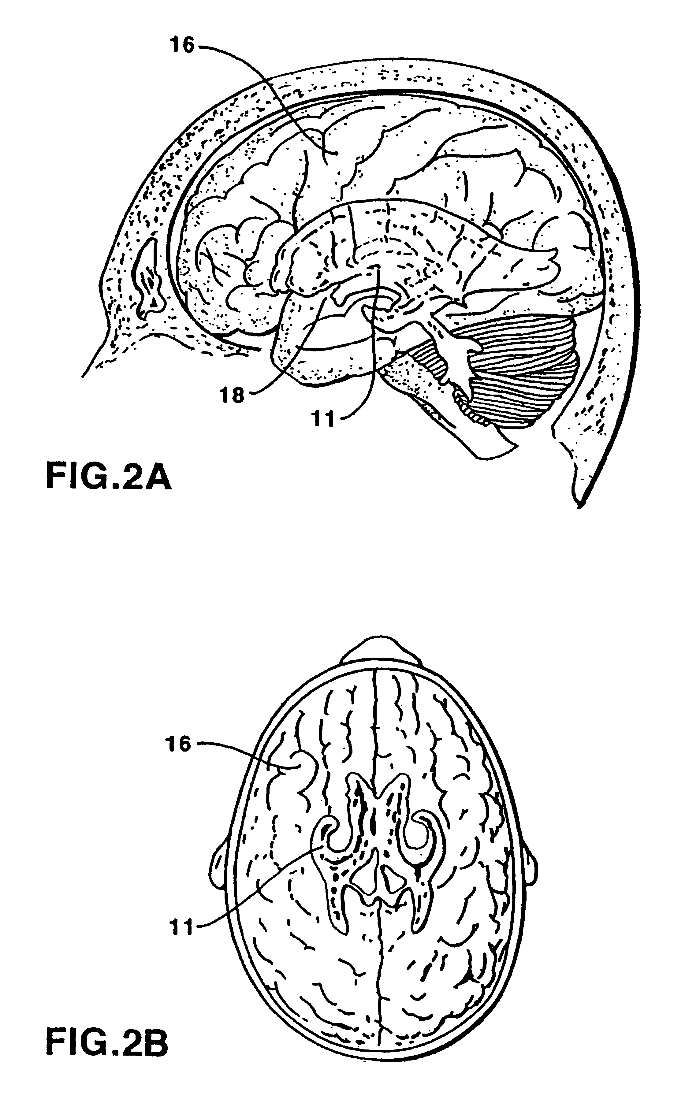 Therapeutic method of treatment of alzheimer's disease