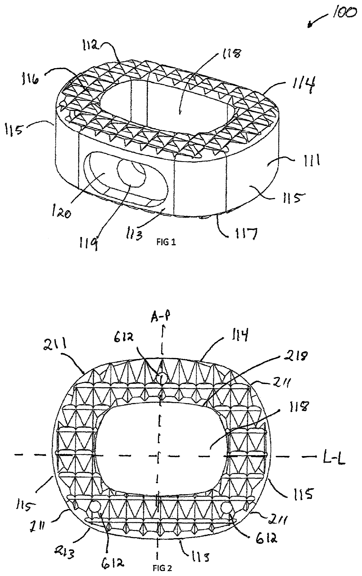 Wedge osteotomy device and method of use