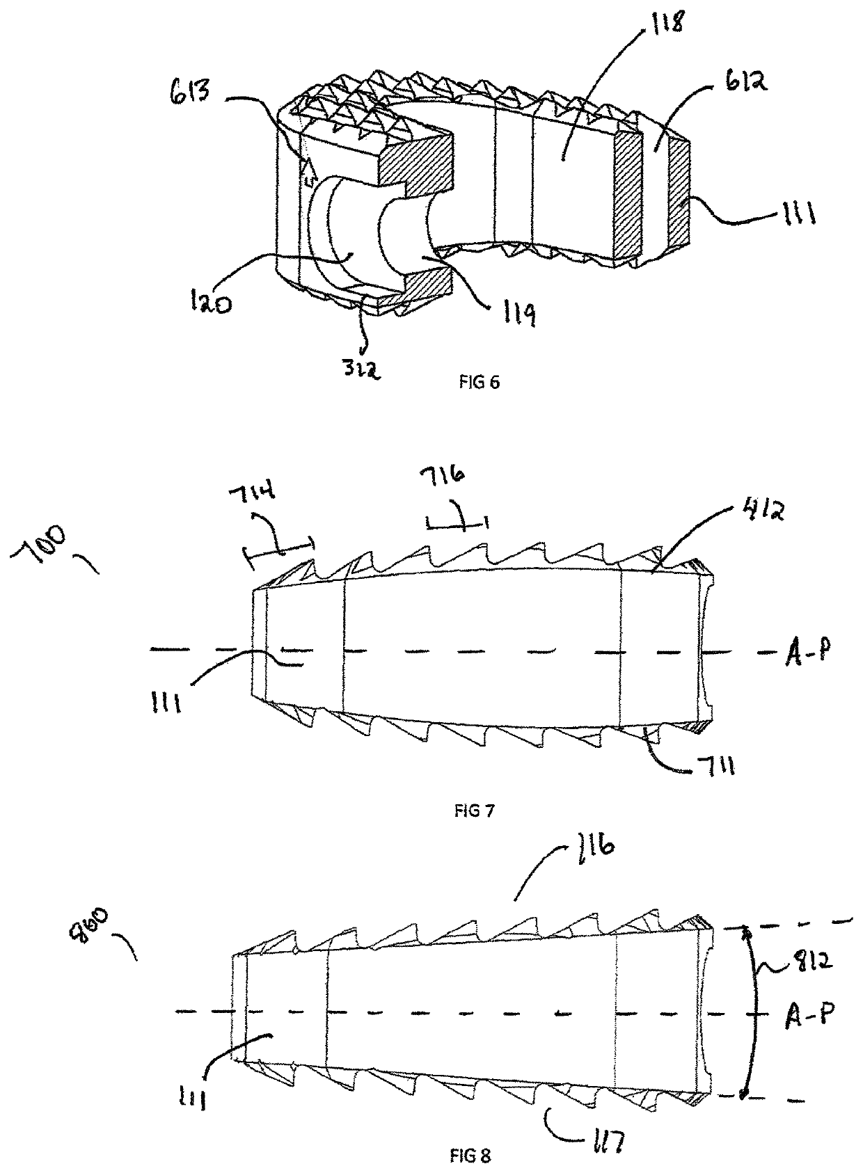 Wedge osteotomy device and method of use