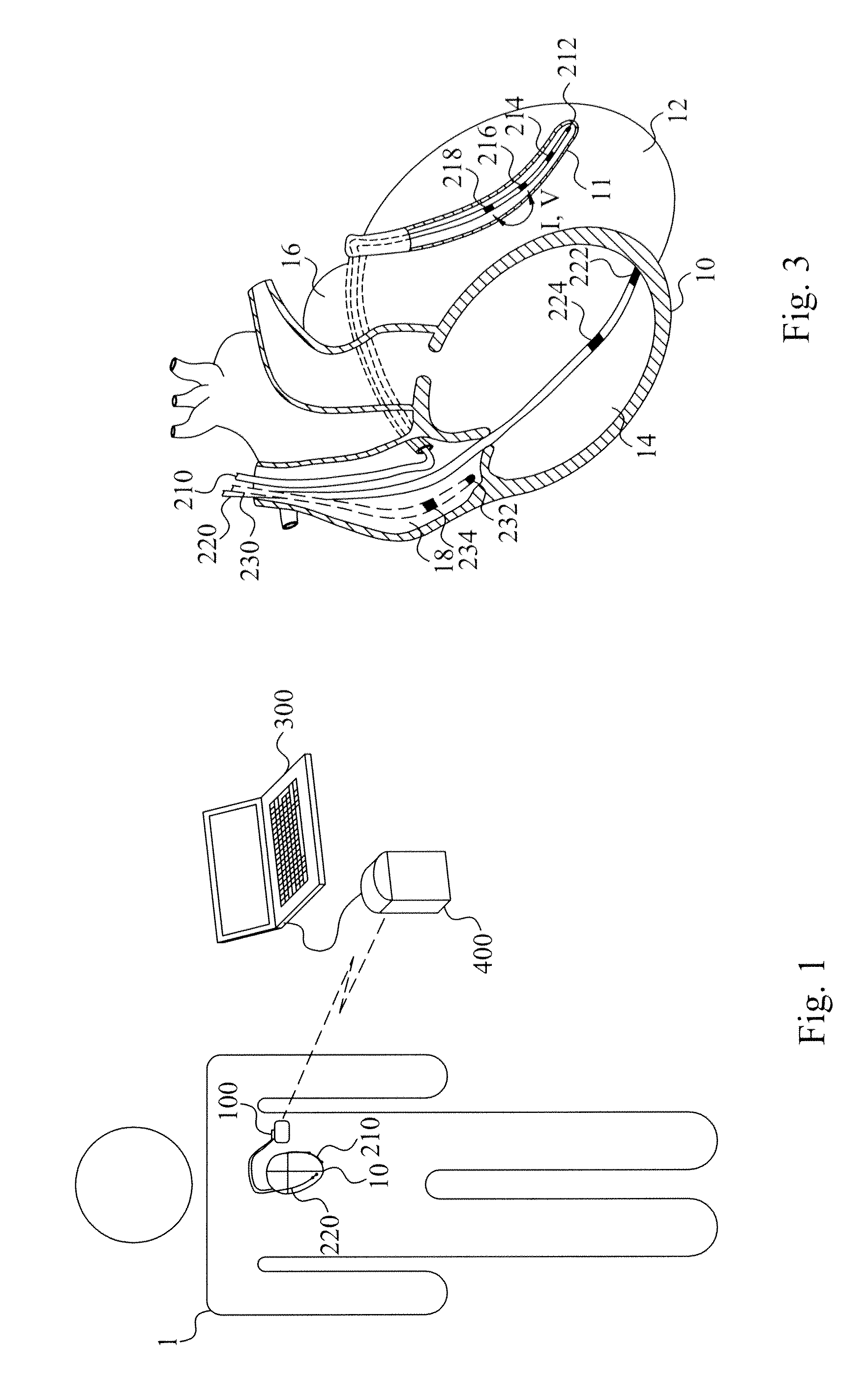 Identification of pacing site