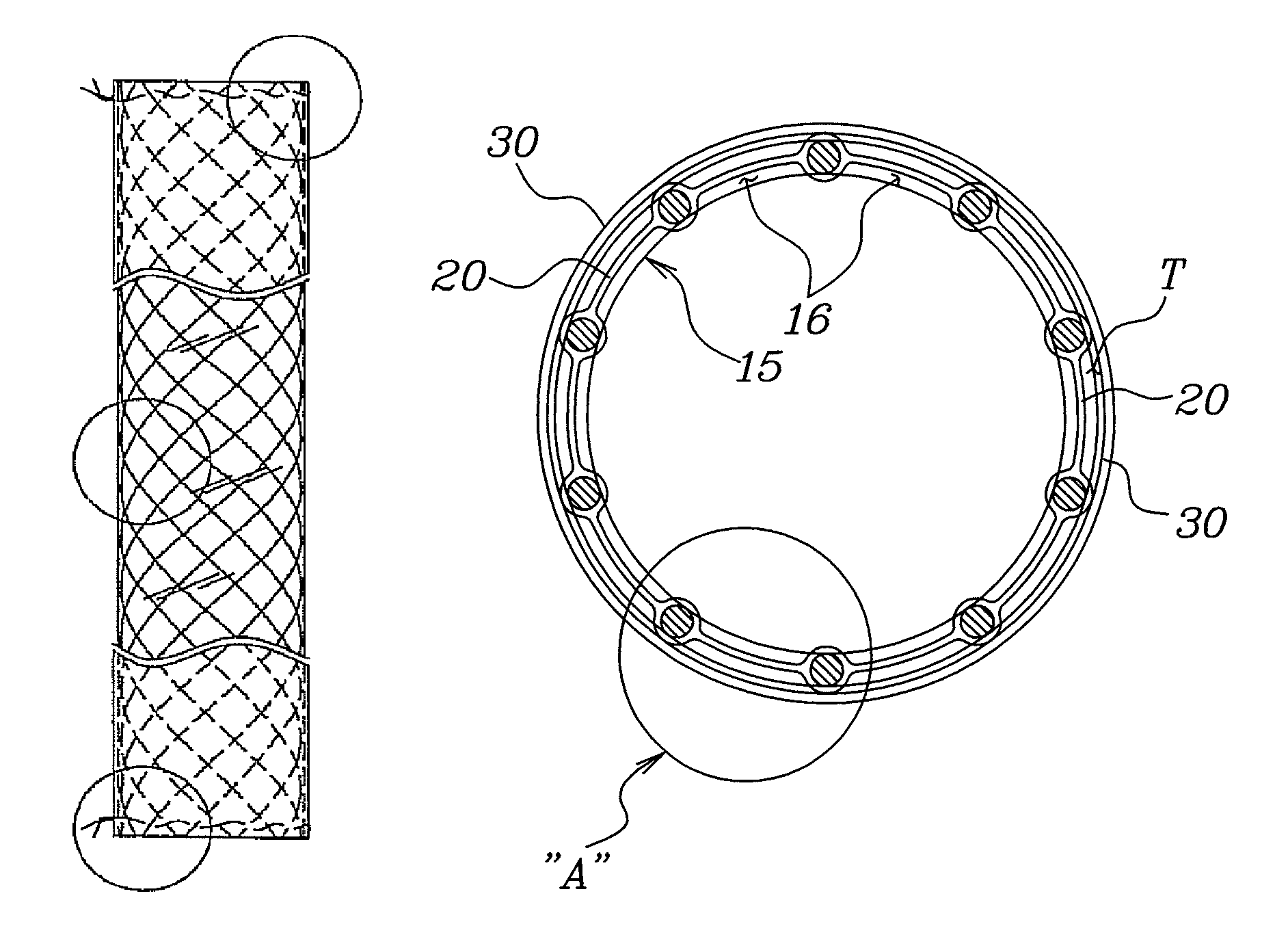 Double-tube type stent