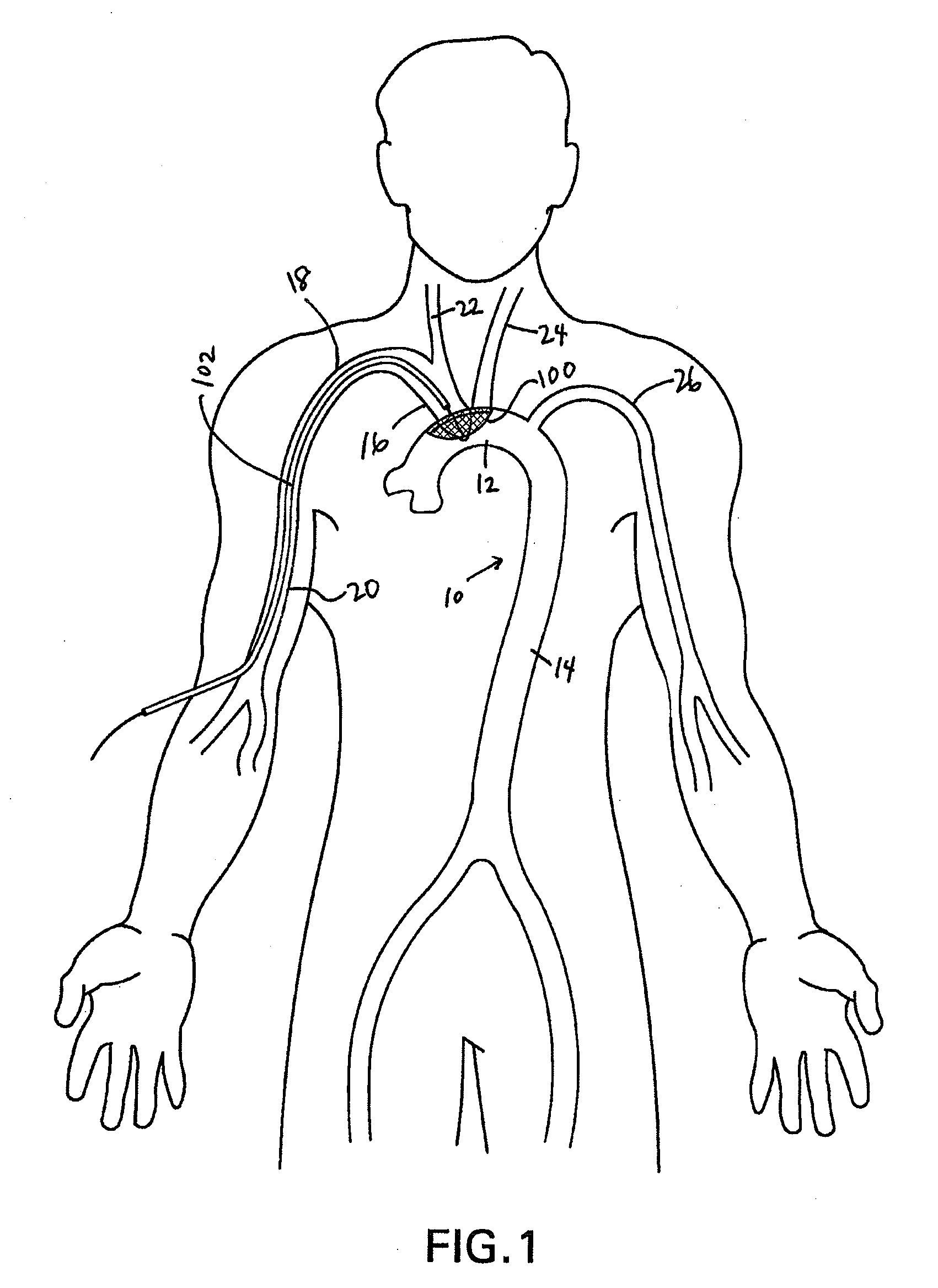 Methods of reducing embolism to cerebral circulation as a consequence of an index cardiac procedure