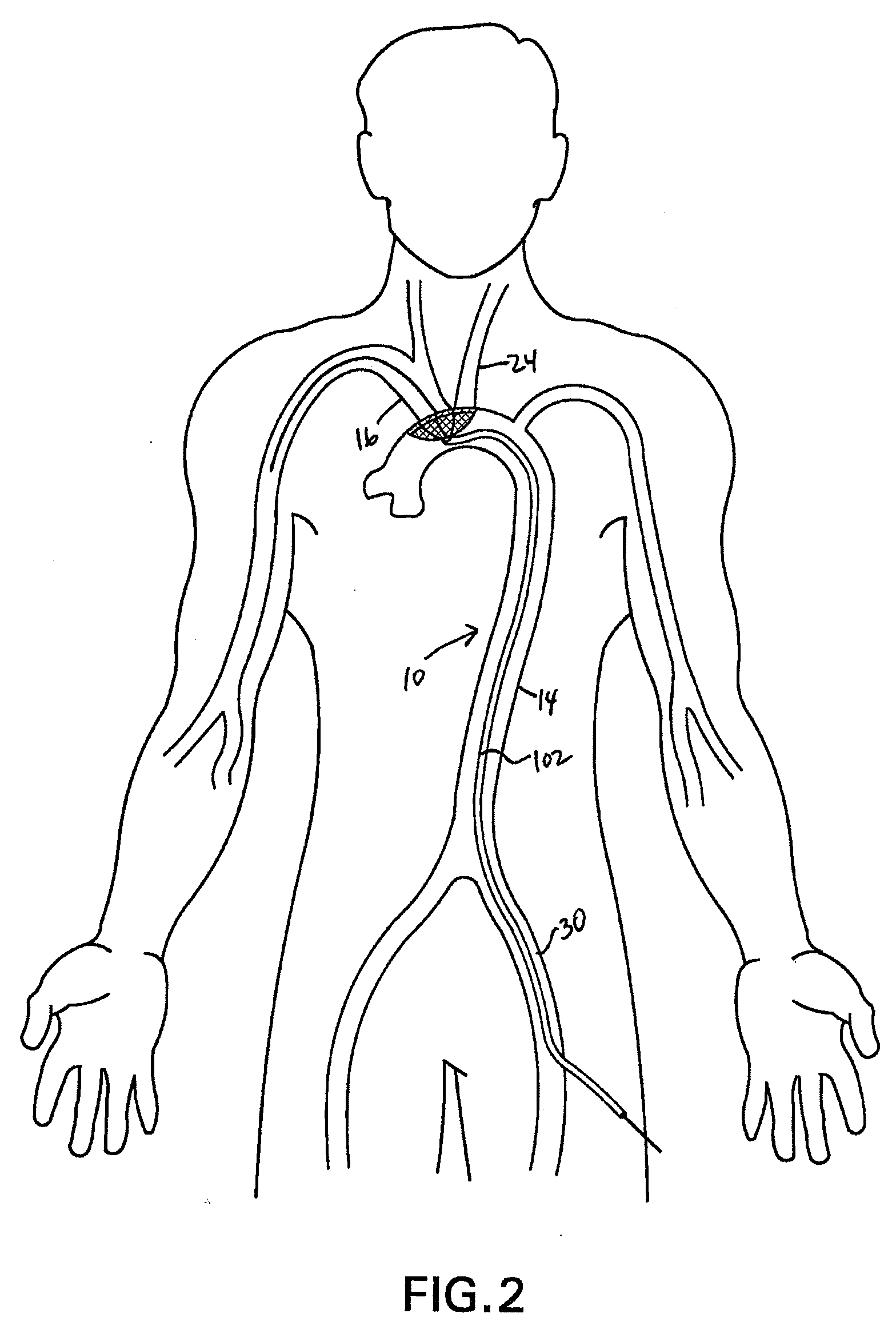 Methods of reducing embolism to cerebral circulation as a consequence of an index cardiac procedure