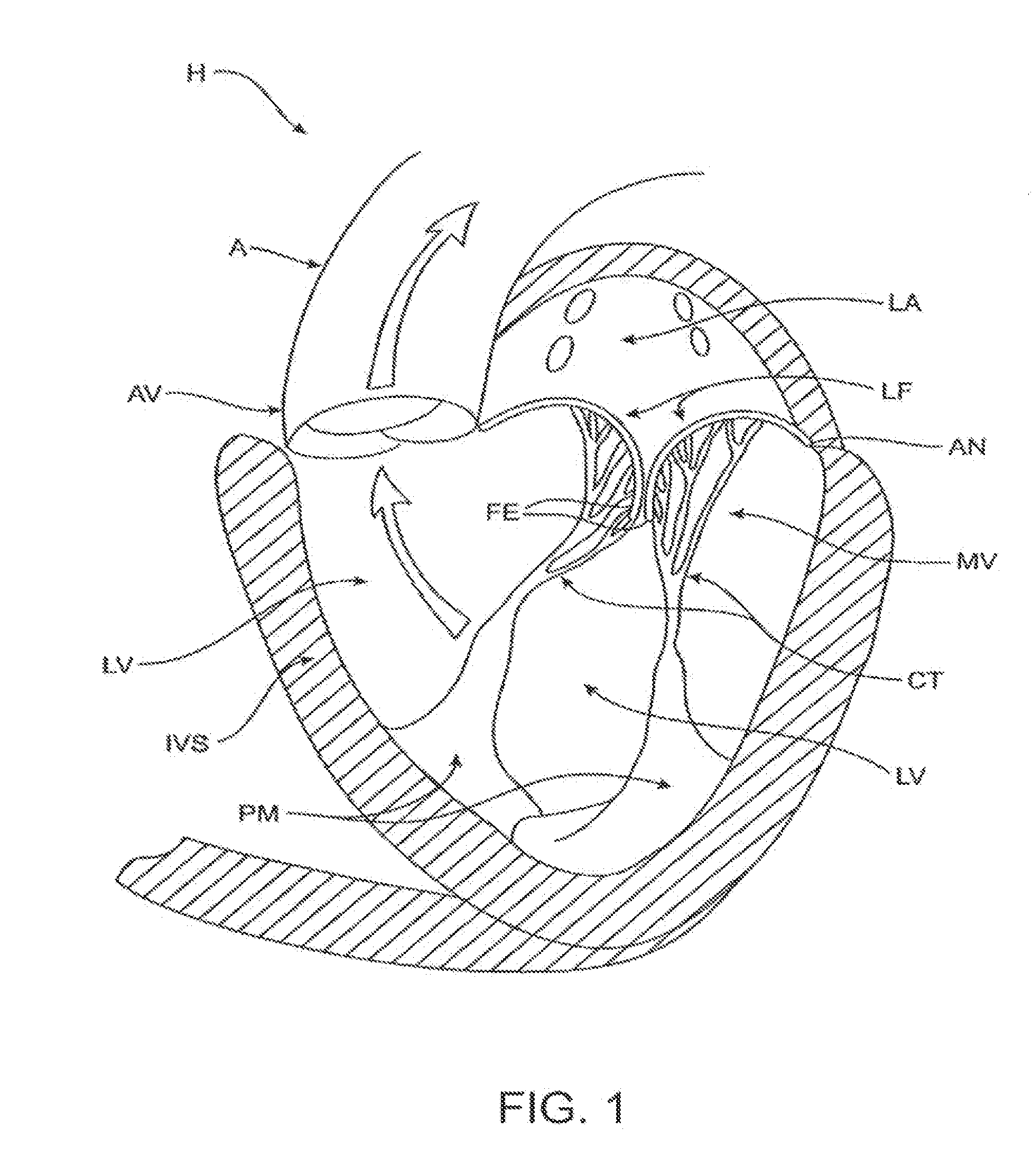 Transcatheter mitral valve prosthesis