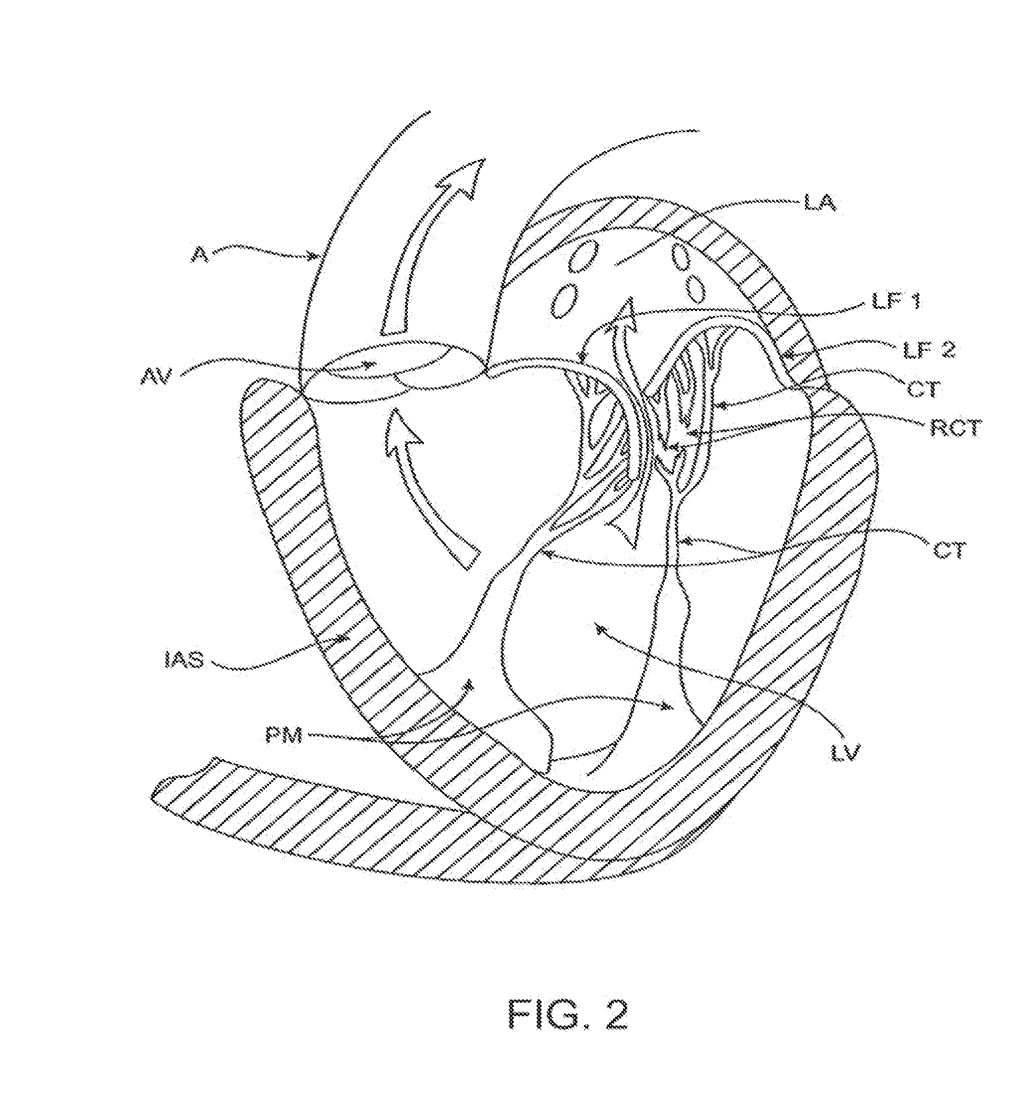 Transcatheter mitral valve prosthesis